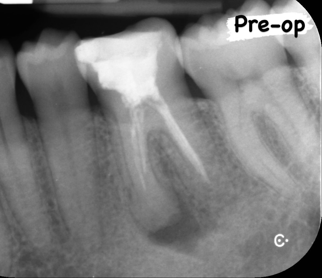 LL6 referred for retreat. Chronic infection. Activated irrigation. Wvc. 3 canals 3 exits Details in comments. #nhs #treat #treatment #endowarrior #endodontia #rootcanaltreatment #rootcanaltherapy #endobelly #waves #waveonegold #saveteeth #endospecialist #treatyourself #simplicity #dentaltreatment #compositebonding #dentistry #endodontics #dentaltreatment #difficultendo #dentistrylife #dentistrylove #dentallife