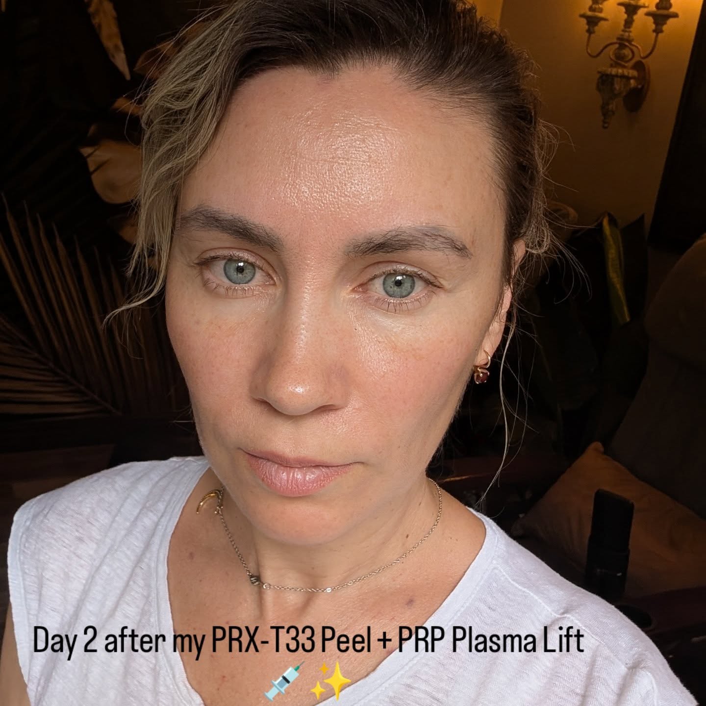 I'm a 43-year-old woman, and like many of us, I’ve started to notice fine lines, aging spots, and sun damage showing up on my skin.
This is my second PRX-T33 peel combined with PRP plasma lift, and I already see real changes. One of my brown spots looks lighter, my skin feels more even, pores are smaller, and everything feels deeply hydrated.
By day 2, the pinkness is gone — just a little tightness, which actually feels great. The doctor injected the plasma so gently, I barely felt anything — no bruising at all, just a tiny spot on the neck.
I’m so happy I started this journey — it feels like my skin is waking up again. 💖✨
MD me with any questions
🔗 lno.care
#PRXT33 #PRPPeel #PlasmaLift #SkinRejuvenation #GlowingSkin #EvenSkinTone #PoreRefining #SkincareResults #BrownSpotTreatment #SkinTransformation
#AntiAgingSkinCare #FacialRejuvenation #YouthfulSkin #CollagenBoost #NonSurgicalGlow #MedicalSpaResults #SkinGlowUp #NoFilterSkin
#lno_boutique