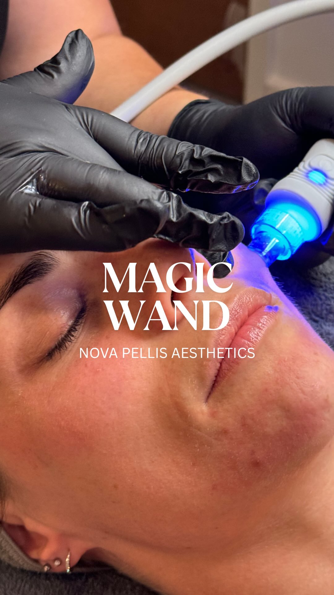 ✨The magic of a Nova Hydrafacial is in the magic wand 🪄
It works like a vaccum, helping activate ingredients penetrate deeper into the skin for maximum results 💦
The result?
A hydrated, radiant, glow from within complexion that turns heads✨
Ready to give your clients glowing results? Drop us a DM.
🌐www.novapellisaesthetics.com
💌info@novapellisaesthetics.com
📱0800 009 6397
📱WhatsApp 07497 831533
#novahydra #novapellis #facial #facialdevice #glowingdkin #skingoals #clinicowners #salonowners #boostrevenues #training #support #skinhealth #bespokefacial #radiofrequency #ems