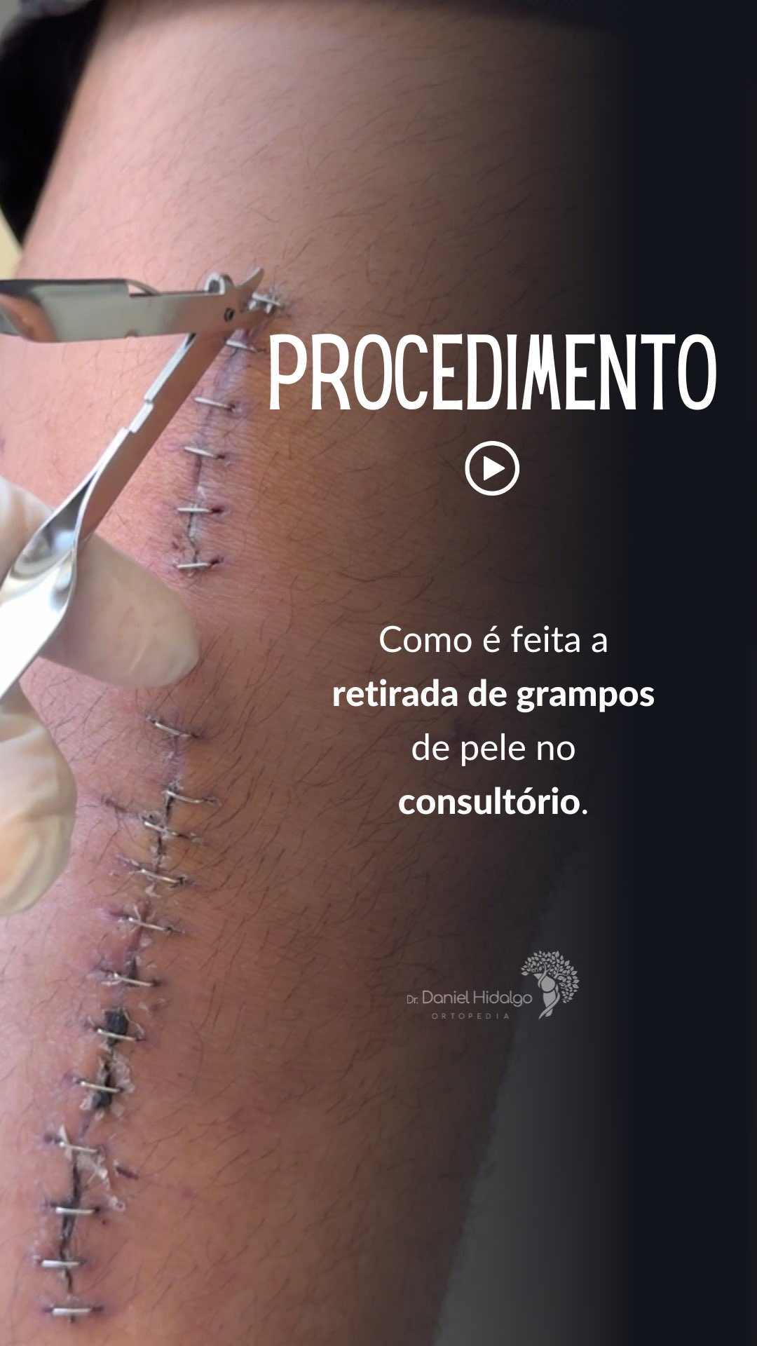 ✨Retirada de grampos usados para suturar a pele após algumas cirurgias #pele #sutura