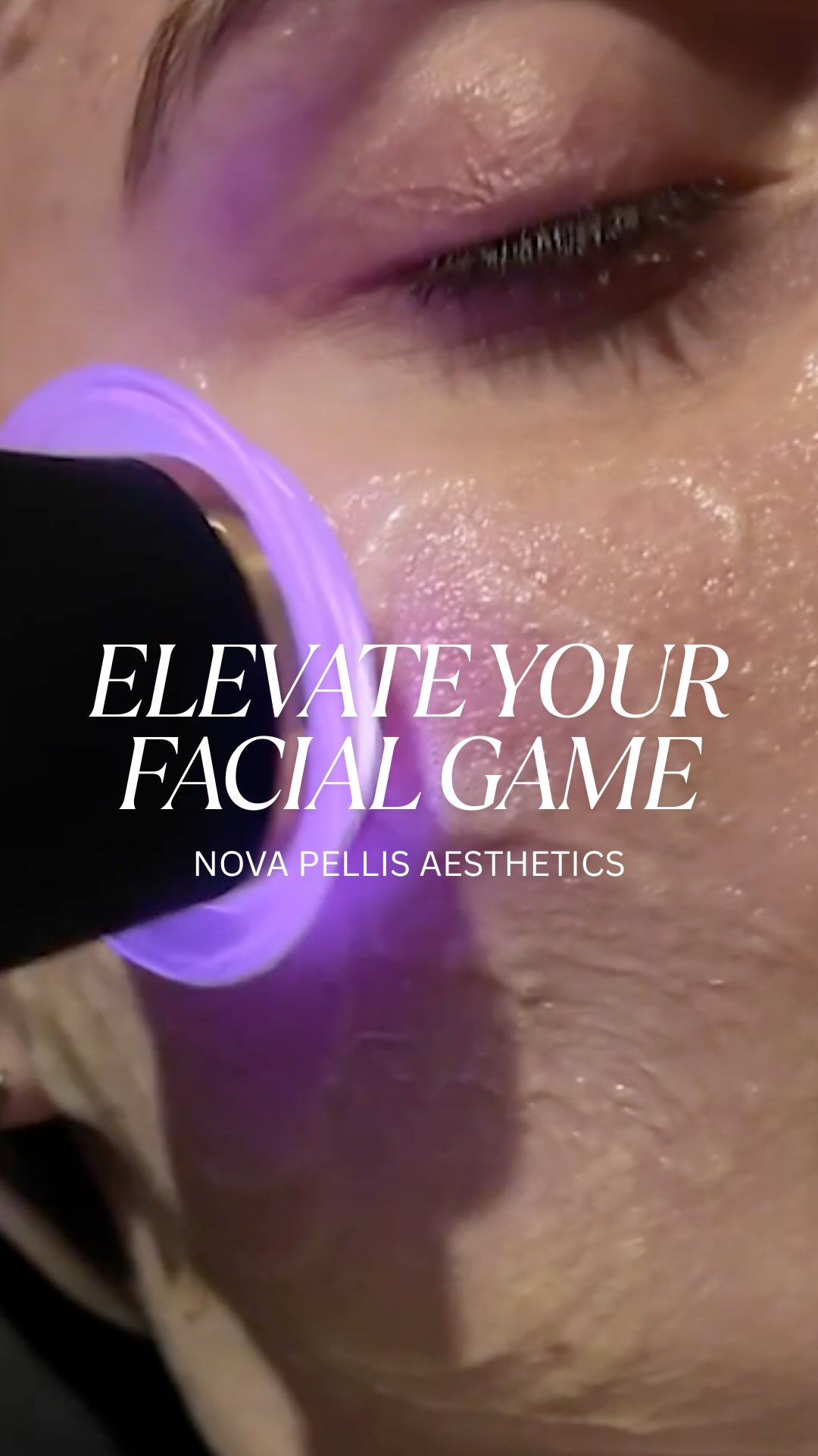 ✨It’s time to elevate your facial game with the ultimate client experience - Nova Hydra Facial.
💧10 Technologies. 1 Powerful Device
💼Affordable consumables, exceptional results, and suitable for all skin types - even the most sensitive.
The Nova Hydra Facial is fully customisable with:
🔷Adjustable intensities
🔷Targeted serums
🔷Tailored treatment durations
Whether your client needs hydration, exfoliation, or a full glow up, this facial delivers brighter, healthier skin after just one session.
💡Perfect for clinics and salons looking to grow their treatment menu and boost revenue.
📩Get in touch with our team at Nova Pellis Aesthetics today to learn more or book a demo.
🌐www.novapellisaesthetics.com
📱0800 009 6397
📱WhatsApp 07497 831533
#novahydra #advancedskincare #clinicupgrade #facialtechnology #skintreatment #glowingskin #beautybusinesstools #aestheticclinics #customfacials #consumables #training