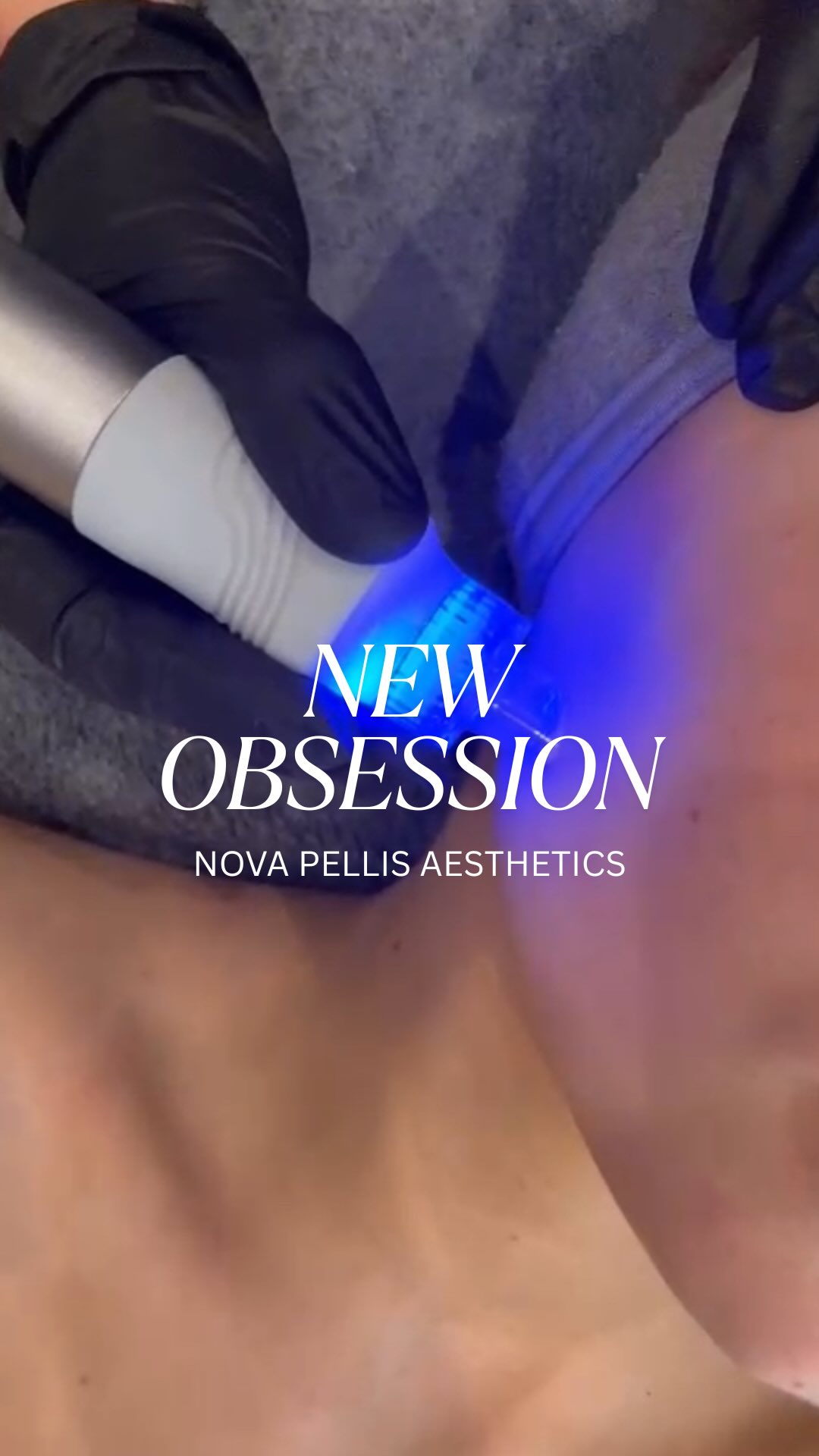 💧Meet the Nova Hydra - where innovation meets results.
This powerful system combines 10 technologies to deliver next-level skin treatments your clients will love.
⚡️Advanced skincare.
📈Affordable consumables - higher profit margins.
🙋♀️Full training included.
🗓️Ideal for clinics ready to scale and attract new clients.
✨Ready to elevate your business?
📩DM us or get in touch with our team to learn more about the Nova Hydra and how it can boost your clinic’s income.
🌐www.novapellisaesthetics.com
📩info@novapellisaesthetics.com
☎️0800 009 6397
📱WhatsApp 07497 831533
#novahydrafacial #aestheticclinics #besutysalon #skintech #clinicgrowth #skincarebusiness #advancedfacials #salonsuccess #glowingskin #skintightening #training #consumables