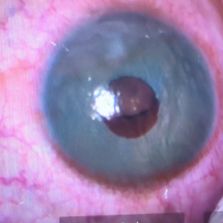 🔹 Première vacation opératoire à la Clinique Noémie de Rothschild (CNR), nouveau centre de référence en ophtalmologie à Paris, spécialisé en :
🔸 chirurgie réfractive (LASIK, SMILE, PKR),
🔸 implants phaques (ICL, IPCL),
🔸 chirurgie de la cataracte,
🔸 greffes de cornée.
Et pour cette première journée : une intervention rare — le retrait d’un implant irien coloré posé il y a... 17 ans !
Probablement un record de longévité pour ce type d’implant, qui entraîne généralement en quelques mois ou années :
➡️ inflammations intra-oculaires sévères,
➡️ glaucome secondaire,
➡️ décompensation endothéliale.
➡️ cataracte
💡 Ce cas souligne les risques associés à ces procédures esthétiques intraoculaires, et l’importance d’une validation scientifique rigoureuse avant leur utilisation en pratique clinique
🔍 #ChirurgieRéfractive #LASIK #SMILE #PKR #ICL #IPCL #ImplantsPhaques #Ophtalmologie #Cataracte #GreffeDeCornée #CliniqueNoémieDeRothschild #OphtalmologueParis