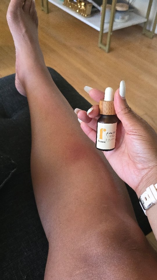 Cellulitis is a common yet potentially serious bacterial infection of the deeper layers of the skin and underlying tissue. It typically causes redness, warmth, pain, swelling, and sometimes fever or flu-like symptoms
The bacteria enter through a cut, insect bite, ulcer, or even cracked skin due to eczema or athlete’s foot.
I think mine came as a result of not lotioning my skin enough or shaving...🤦🏾♀️
#cellulitis #bacterialinfections #skininfection #calmoil