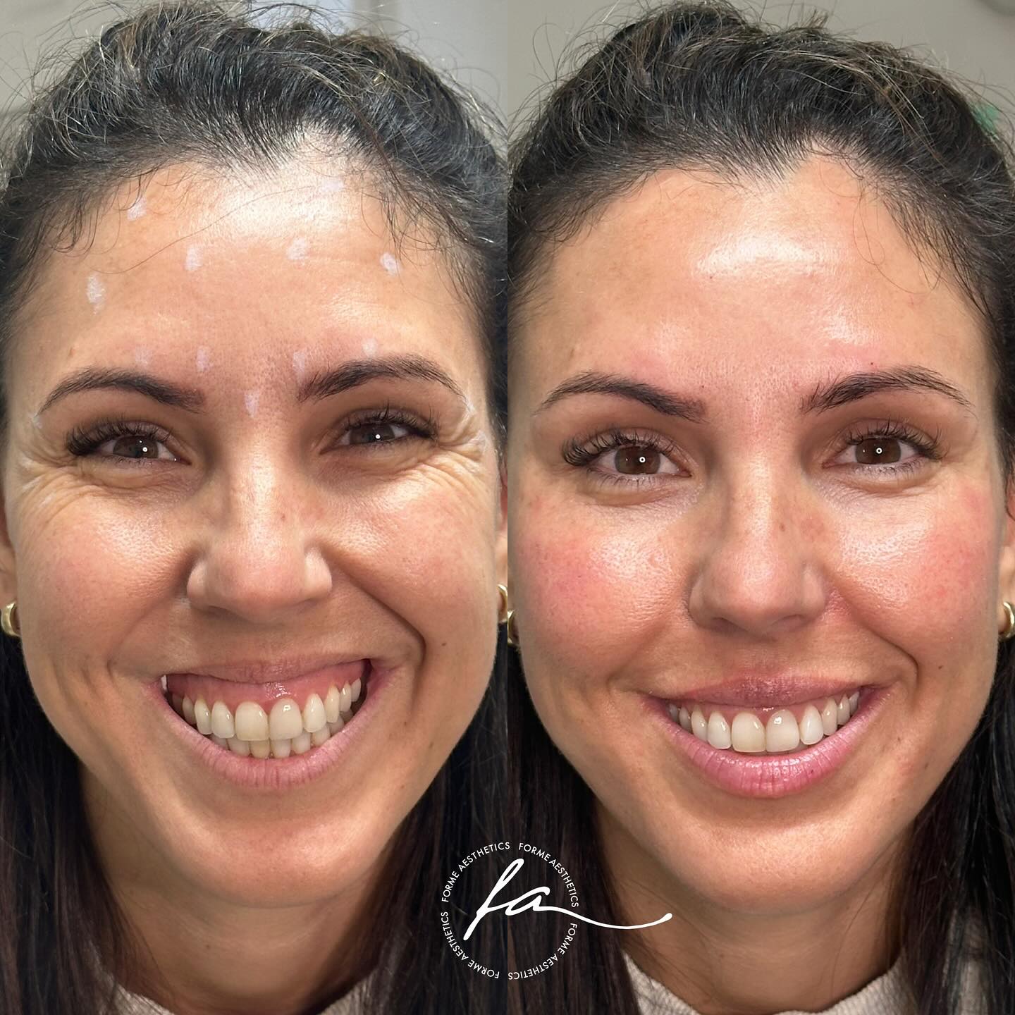 This patient came to Forme Aesthetics with concerns about facial volume loss and lines that appeared with movement. After a thorough consultation and clinical assessment, a tailored treatment plan was developed to support her individual concerns.
All procedures are performed by a qualified health professional using evidence-based techniques and clinical protocols to ensure safe and appropriate care.
All medical treatments carry risks. It’s important to consider this information carefully and seek a second opinion from a qualified health practitioner if needed. Outcomes can vary from person to person.
Image shared with patient consent.
Treatment by Stephanie Sirillas RN
AHPRA: NMW0001907789