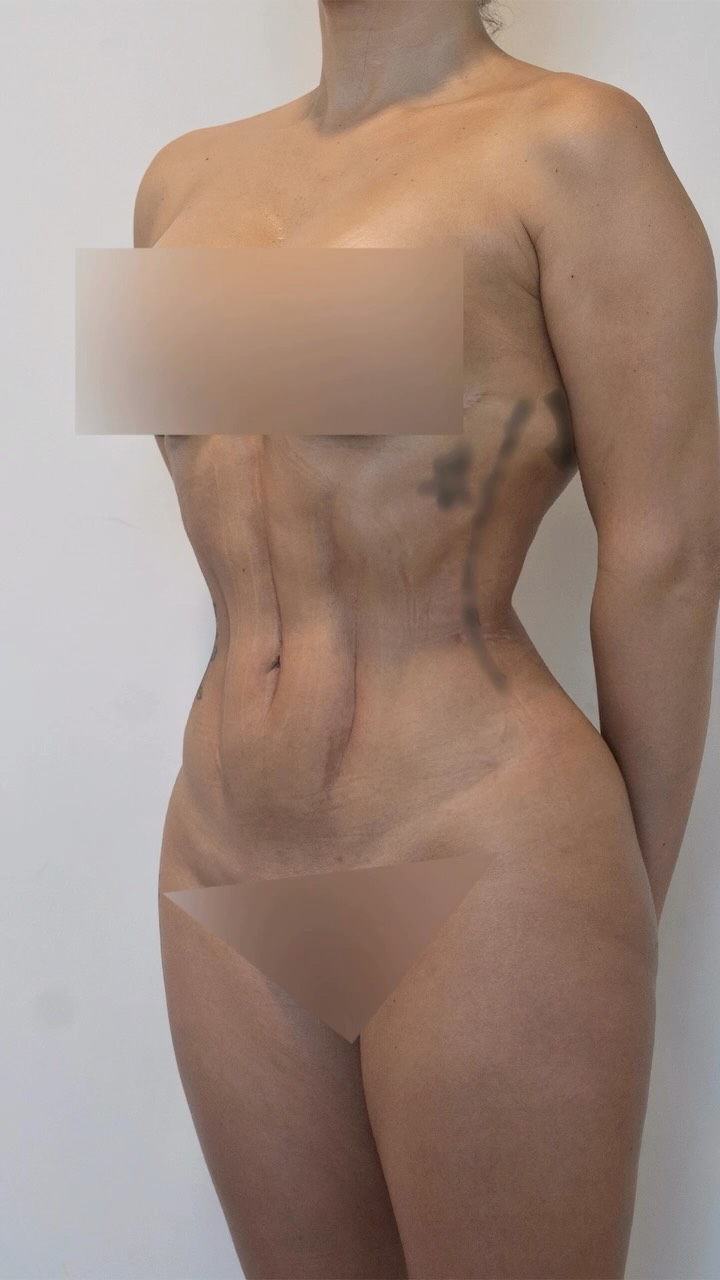 ✨Hoy queremos mostrarles este hermoso resultado de 1 mes de evolución, esta paciente se realizó una lipoescultura con marcacion abdominal, Ribxcar y transferencia de grasa a las caderas!
❗️Este no es el resultado definitivo ya que la marcación todavía está muy marcada, todavía existe inflamación en la zona, con el tiempo se verá más natural!
En este caso la paciente perdió más de 14cm en la zona de la cintura! ❤️🔥