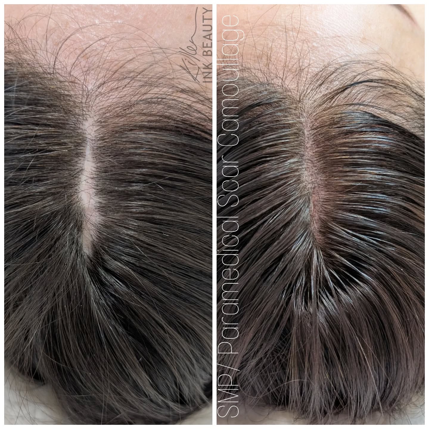 This client experienced significant scalp trauma, resulting in a visible scar. We used a combination of Scalp Micropigmentation (SMP) and paramedical tattooing to help restore a more natural and balanced appearance.
SMP replicates the look of natural hair follicles by implanting tiny pigment deposits into the scalp, creating the illusion of density. Paramedical tattooing blends the scar tissue with surrounding skin by restoring lost pigment, reducing contrast, and softening the overall look.
These non-surgical treatments offer a long-term solution for scar camouflage, helping clients regain confidence after trauma or surgery.
#ScalpMicropigmentation #ParamedicalTattooing #ScarCamouflage #HeadTraumaScar #SMPforScars #MedicalTattooing #ScarRestoration #NonSurgicalHairRestoration #MedicalAesthetics #VancouverTattooArtist #CalgaryTattooArtist #VancouverSMP #CalgarySMP