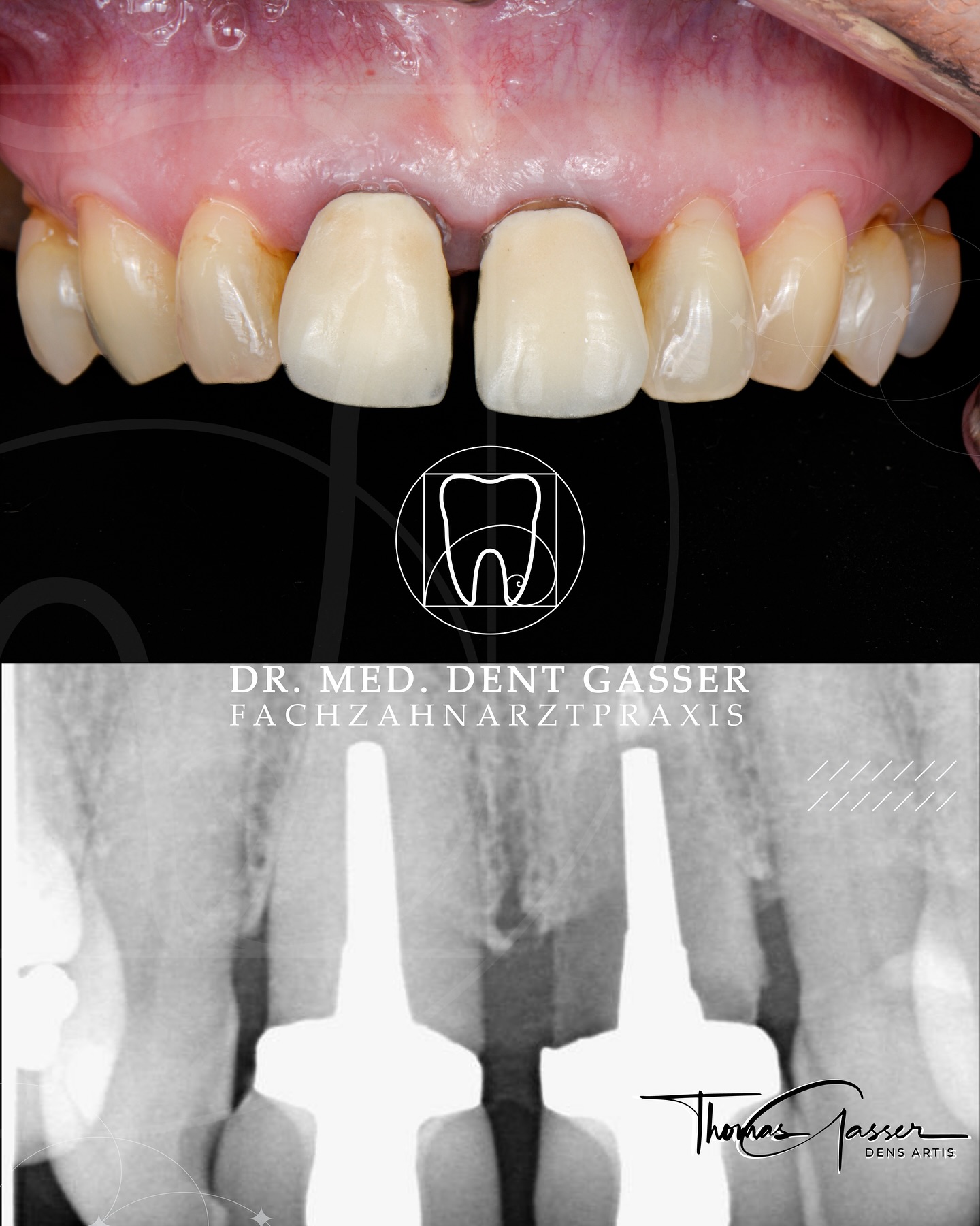 🦷 Sofortimplantate neu gedacht: Ästhetisch, stabil und in einer Sitzung
Ein fehlender Zahn belastet nicht nur das Kauen, sondern oft auch das Selbstbewusstsein. Die moderne Sofortimplantation ermöglicht in vielen Fällen, Zahnextraktion, Implantatsetzung und ein festsitzendes Provisorium in nur einer Behandlung zu kombinieren – ohne monatelange Zahnlücke oder herausnehmbare Provisorien.
➡️ Nach sorgfältiger Diagnostik wird das Implantat direkt gesetzt und die natürliche Zahnfleischarchitektur erhalten – für ein harmonisches, gesundes Erscheinungsbild.
➡️ Sofortimplantate bieten eine besonders effiziente Versorgung, die weniger Sitzungen erfordert und meist mit geringerer Belastung verbunden ist.
💡 Vorteile moderner Sofortimplantate:
✔️ Fester Zahn sofort nach der Entfernung
✔️ Erhalt der natürlichen Zahnfleischkontur
✔️ Weniger Schmerzen, schnelle Heilung
✔️ Weniger Sitzungen – effizient und komfortabel
✔️ Kein herausnehmbares Provisorium
✔️ Je nach Situation auch kostengünstiger
⚠️ Nicht bei jedem Patienten ist diese Methode möglich – wir prüfen jede Situation individuell und beraten Sie umfassend.
Die Sofortimplantation ist heute weit mehr als nur „Lücke schließen“ – sie ist ein innovatives Konzept für funktionelle Stabilität, Ästhetik und Lebensqualität.
📍 Fachzahnarztpraxis Dr. Thomas Gasser
Greifengasse 1, 4058 Basel
📞 +41 61 681 00 10
📧 fachzahnarztpraxis_basel@sso-hin.ch
🌐 www.densartis.ch
#Sofortimplantat #Zahnimplantat #FesterZahn #Implantologie #ZahnarztBasel #Basel #BaselSchweiz #ÄsthetischeZahnmedizin #Zahnerhalt #Minimalinvasiv #Zahnästhetik #Zahnarztpraxis #GesundesLächeln #DrThomasGasser #BaslerZahnarzt #ZahnmedizinMitHerz #Straumann #ITI
