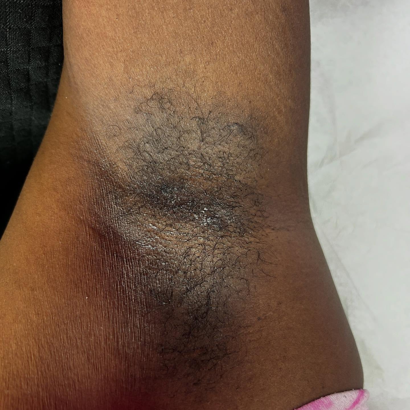 Did You Know :
Waxing weakens the papilla, which can eventually stop hair growth. However, because each individual hair within the same follicle is in any one of the three stages at once, waxing only destroys the hair in the follicle they are in the anagen phase with each waxing service.
#waxspecialist #bodywax #waxingspecialist #legwaxing #eyebrowwax #facialwaxing #browwaxing #fullbodywaxing #facials #bodywaxing #Atlantawax #Atlwax #fyp #explorepage #bodycontouring #Bodysculpting #atl #Atlanta #Facial #facials#Foryoupage #Waxing #waxatlanta #Waxatl
Waxing is a temporary hair removal process that involves applying wax directly to the skin and then removing the hair and wax all at once. What is a Brazilian wax? A Brazilian wax is a waxing service that completely removes pubic hair from the front, upper thighs, and butt. Based on your personal preference, you can leave a small strip of hair, a triangle, or square on the front.