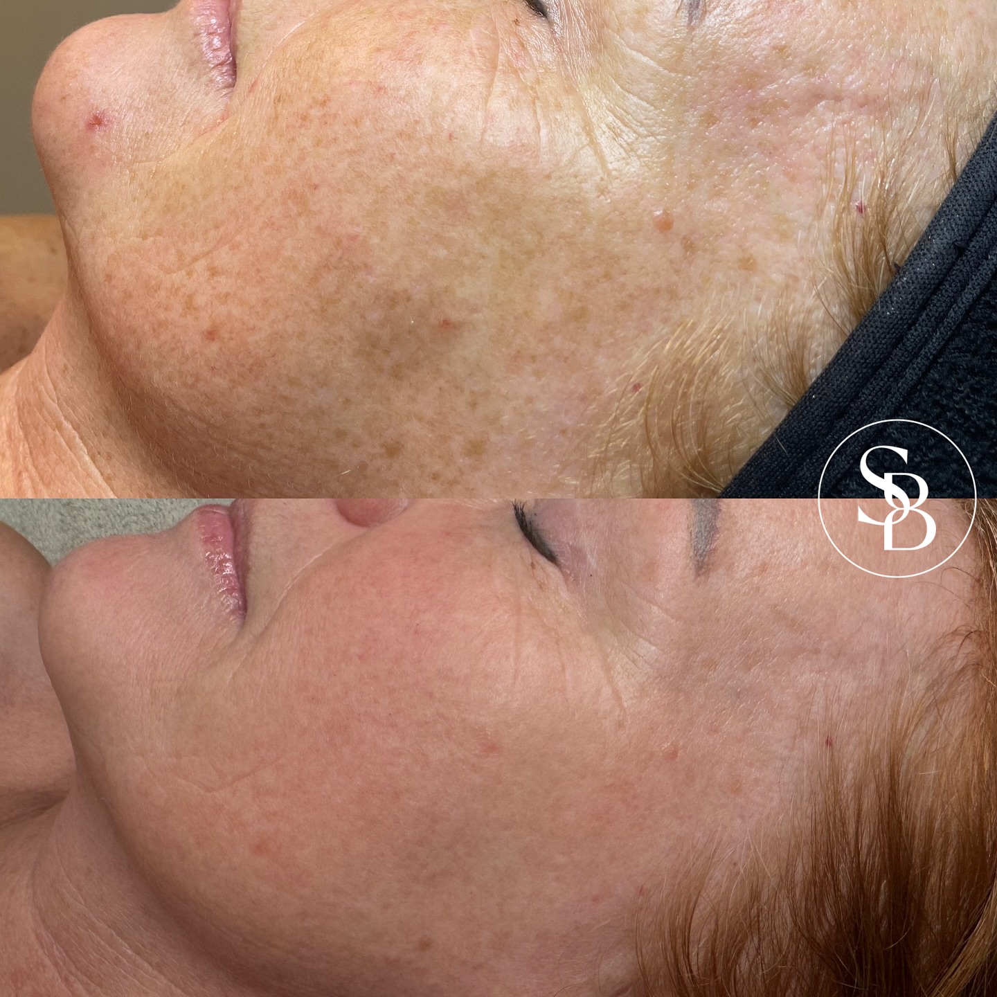 Say goodbye to unwanted pigment - without the thousand dollar price tag 🤭
Sunspots, redness, and uneven skin tone can feel impossible to hide, but IPL rejuvenation makes it possible.
$300 per treatment
#iplrejuvenation #m22lumenis #depigmentation