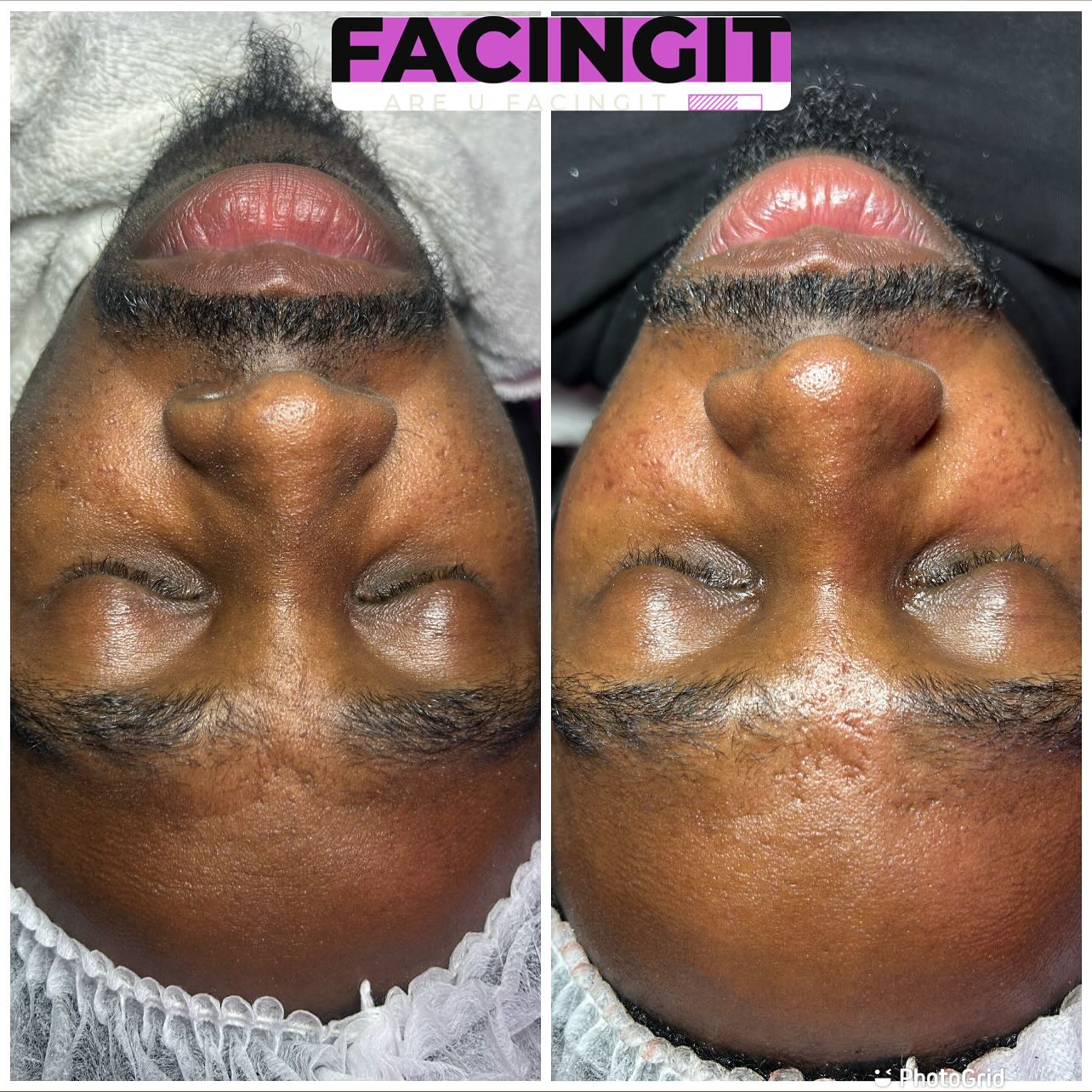 #dermaplaningfacials #facialatlanta #atlantaspa #atlantaskincare #clearskin #explorepage #vacuumtherapy #facials #lymphaticdrainage #collegeparkga #blackesthetician #eastpointga #Atl #beautiful #facialsatl #spaday #menfacial #dayspa #hairremoval #aesthetics #facialtreatment #blackowned #estheticianatlanta #facingit #extractions #atlanta #naturalskincare #blackheadremoved #atlantastylist #atlantahairstylist