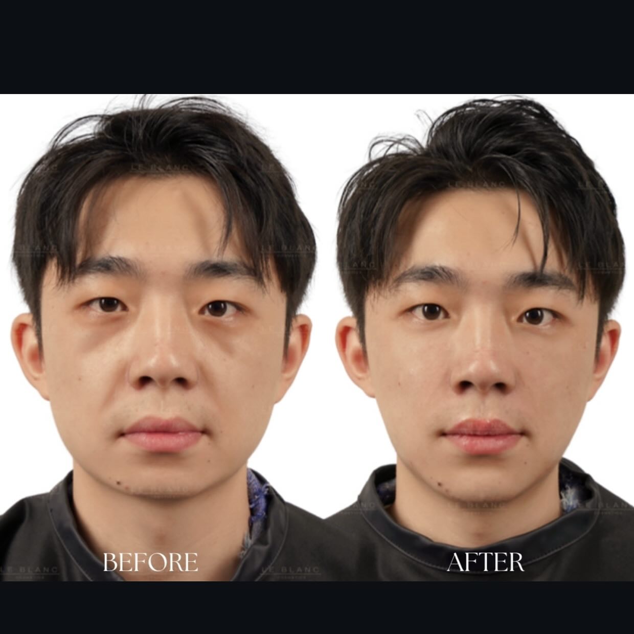 Men’s Skin Boost ✨💪
This isn’t your average facial — it’s a full upgrade.
✔️ Skin tightening with Microchanneling
✔️ Brightens dull, tired skin
✔️ Targets dark circles
✔️ Boosts collagen for smoother, firmer texture
🧖♂️
#MensFacial #Microchanneling #DarkCircleTreatment #SkinTightening #BrightSkin #PasadenaFacial #GlowUpForMen #Microbrading #microshading #alhambra #pasadena #archadia #eyelashextensions #permanentmakeup #groupon #powderbrows #tatoomakeup #eyebrowstint #tint #browlamination #pasadenanails #pasadenahairstylist #pasadenaeyelashextensions #pasadenabrowshaping