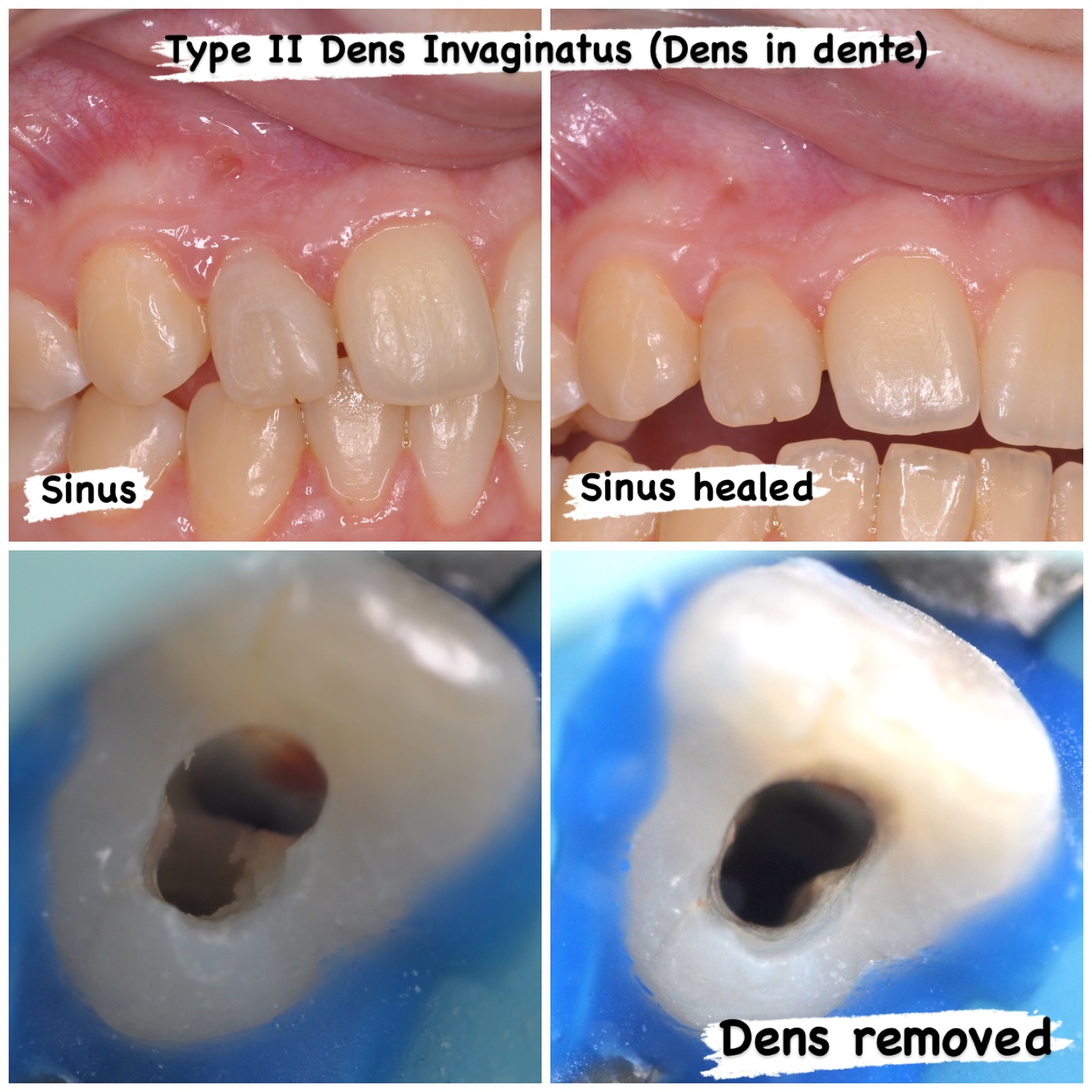 UR2 referred for chronic sinus associated with discolouration. Type II Oehler Dens Invaginatus diagnosed. 2 visit treatment. Details in comments. #nhs #treat #treatment #endowarrior #endodontia #rootcanaltreatment #rootcanaltherapy #endobelly #waves #waveonegold #saveteeth #endospecialist #treatyourself #simplicity #dentaltreatment #compositebonding #dentistry #endodontics #dentaltreatment #difficultendo #densindente #densinvaginatus