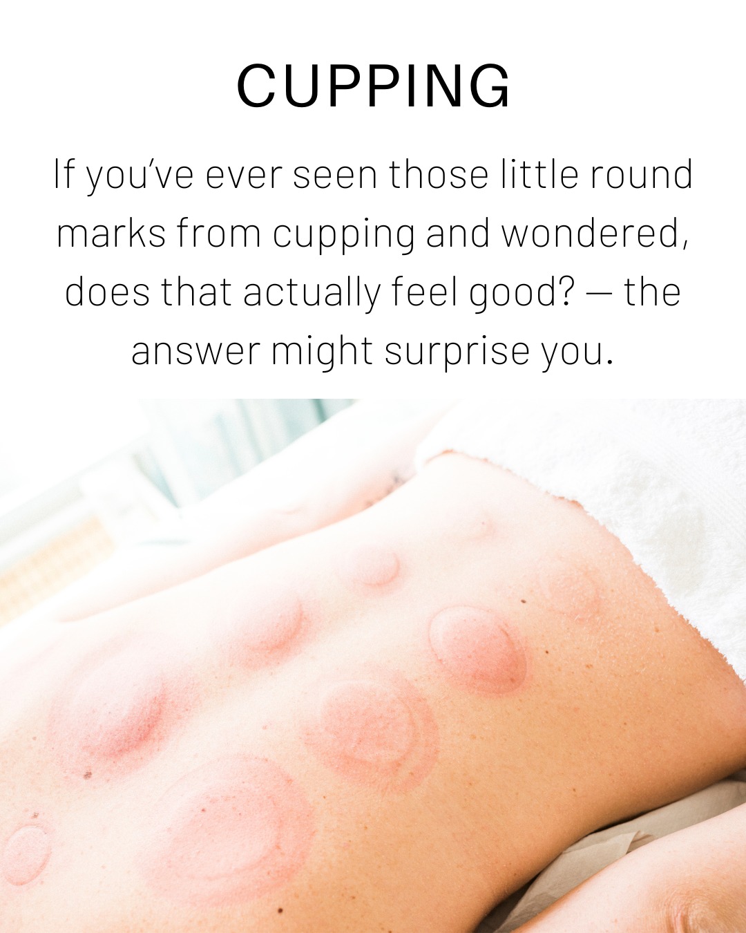 Cupping is an ancient therapy that melts tension, moves stagnation, and leaves you feeling lighter—inside and out. It is one of the most-loved therapies in Traditional Chinese Medicine—and once you try it, you’ll understand why.
It’s not painful. In fact, it’s often deeply relaxing.
By creating suction on the skin, cupping helps:
- Release tension in the muscles and fascia
- Stimulate blood and lymph flow
- Draw out stagnation
- Ease pain, stiffness, and fatigue
What many people love about cupping is how fast they feel results—especially when muscles feel stuck, sore, or “locked in.” The marks left behind (if any) aren’t bruises—they’re signs of circulation waking up and old stagnation being cleared.
From weekend warriors to desk-dwellers, cupping brings relief and renewal.
And it’s not just for pain—cupping can support the immune system, aid digestion, and calm the nervous system too.
Curious to try cupping or want to know if it’s a good fit for your condition? Feel free to reach out—I’d be happy to walk you through it and answer any questions.
#CuppingTherapy
#TCMHealing
#CirculationBoost
#MoveYourQi
#HolisticRelief