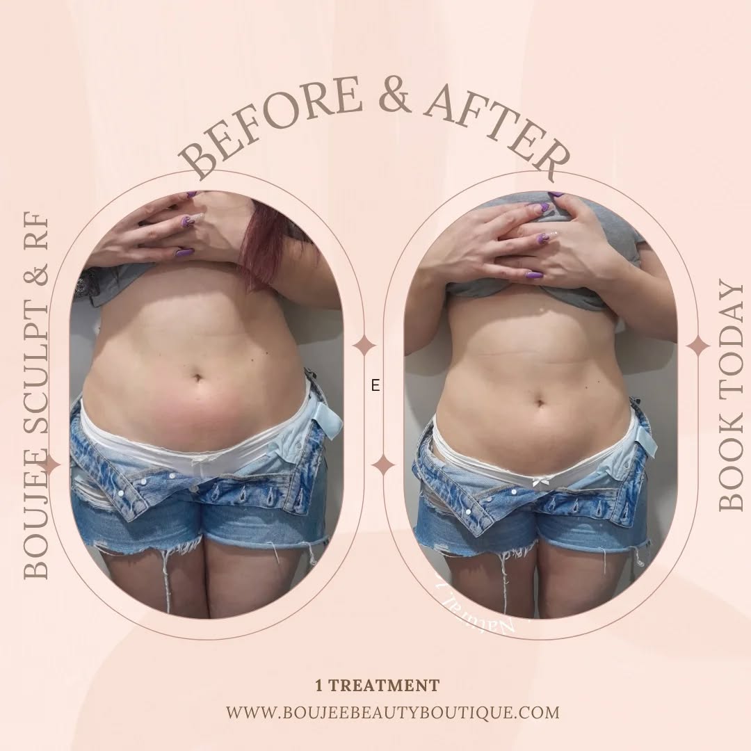 Boujee Muscle Sculpt + Radio Frequency for this client.
This non-invasive treatment helps tone muscles, sculpt your body, and may support up to 3cm+ in targeted areas per session immediately. 💁♀️
( results vary per individual.)
Perfect for anyone looking for definition, improve their shape without downtime! Quick, simple, and seriously effective. 💫
📩 DM to book or learn more.
#BoujeeMuscleSculpt #BodyContouring #ToneAndSculpt #NonInvasiveResults #adelaideweightloss #adelaidebeautysalon