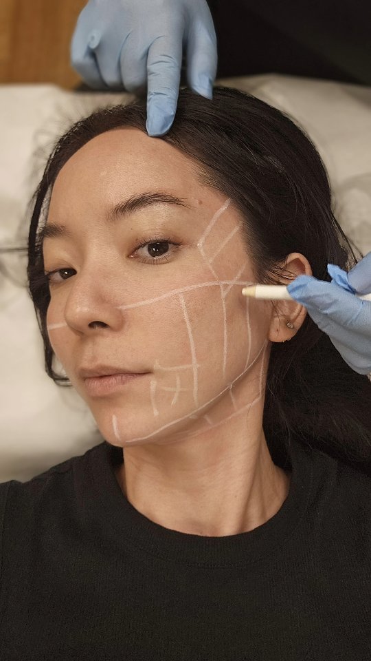 Snatched without the scalpel 💁♀️✨
Ultherapy Prime = the Korean V-Lift secret to a tighter, smoother jawline — no needles, no downtime, just vibes + collagen.
This next-gen treatment uses micro-focused ultrasound energy to stimulate your body’s collagen production for firmer, more lifted skin.
🔊 Precise ultrasound = deeper lift
💆♀️ Natural results in 3–6 months
🙌 Zero downtime, max glow
🔬 Triggers your body’s collagen production
✅ FDA-cleared
Your selfie game won’t know what hit it. Think of it as your future face—tightened, defined, and refreshed.
#UltherapyPrime #SnatchedJawline #CollagenLift #NonSurgicalVlift #KBeautyTightening
#SnatchedJawline #UltherapyPrime #VliftMagic #NoNeedlesNeeded #GlowUpSeason