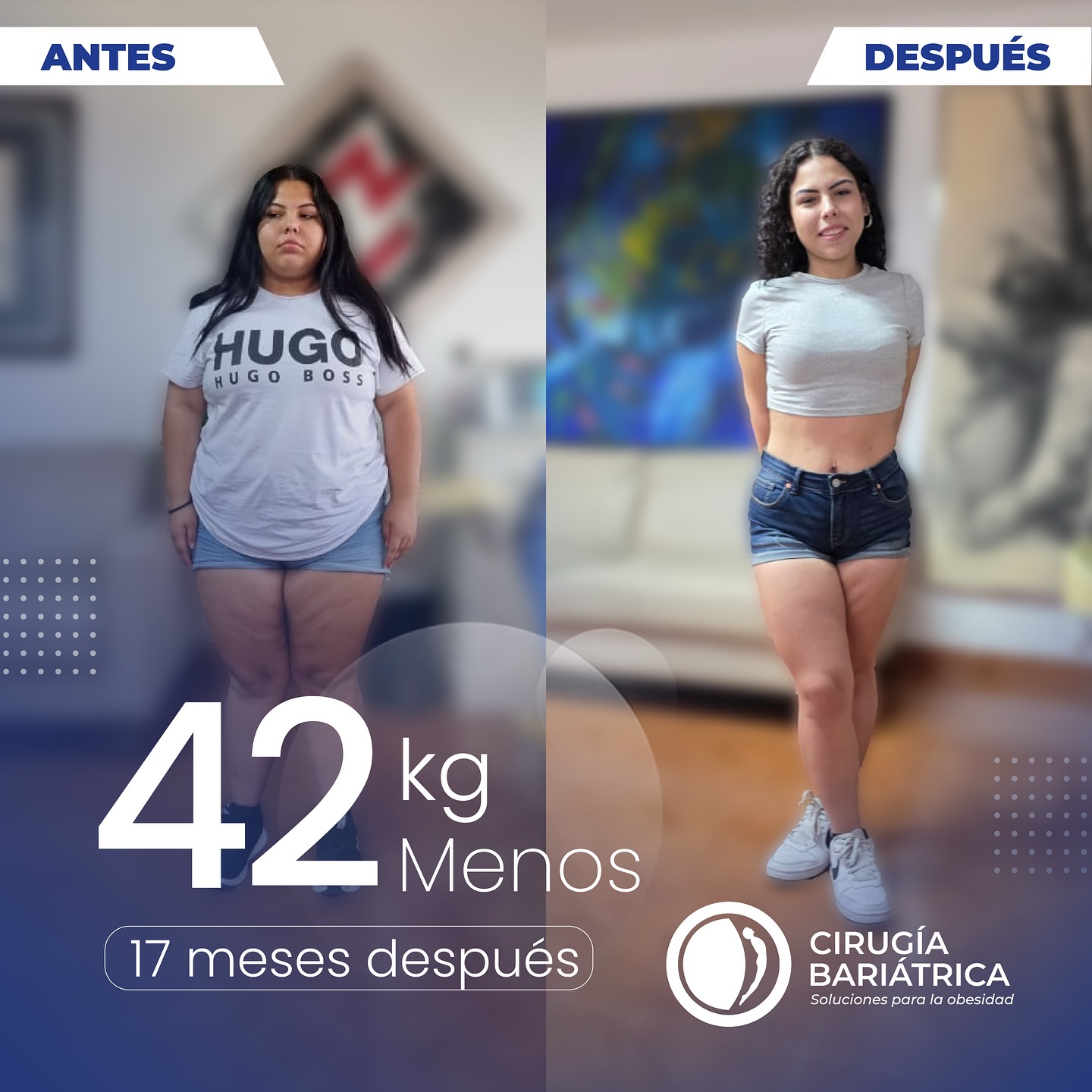 Ella ha perdido 42 kilos en 17 meses gracias a la cirugía bariátrica del Dr. Bolaños y su equipo. Hoy disfruta de resultados increíbles, felicidad renovada y una calidad de vida que la inspira a seguir adelante. ¡Una transformación que habla por sí sola!✨❤️🌷
She has lost 42 kilos in 17 months thanks to bariatric surgery performed by Dr. Bolaños and his team. Today, she enjoys amazing results, renewed happiness, and a quality of life that inspires her to keep moving forward. A transformation that speaks for itself! ✨🌷❤️
#bariatric #bariatrica #weightlosssurgery #weightlossjourney #weightlossdiet #bariatricsurgery #cirugiabariatrica #health #healthy #healthyliving #healthandwellness
