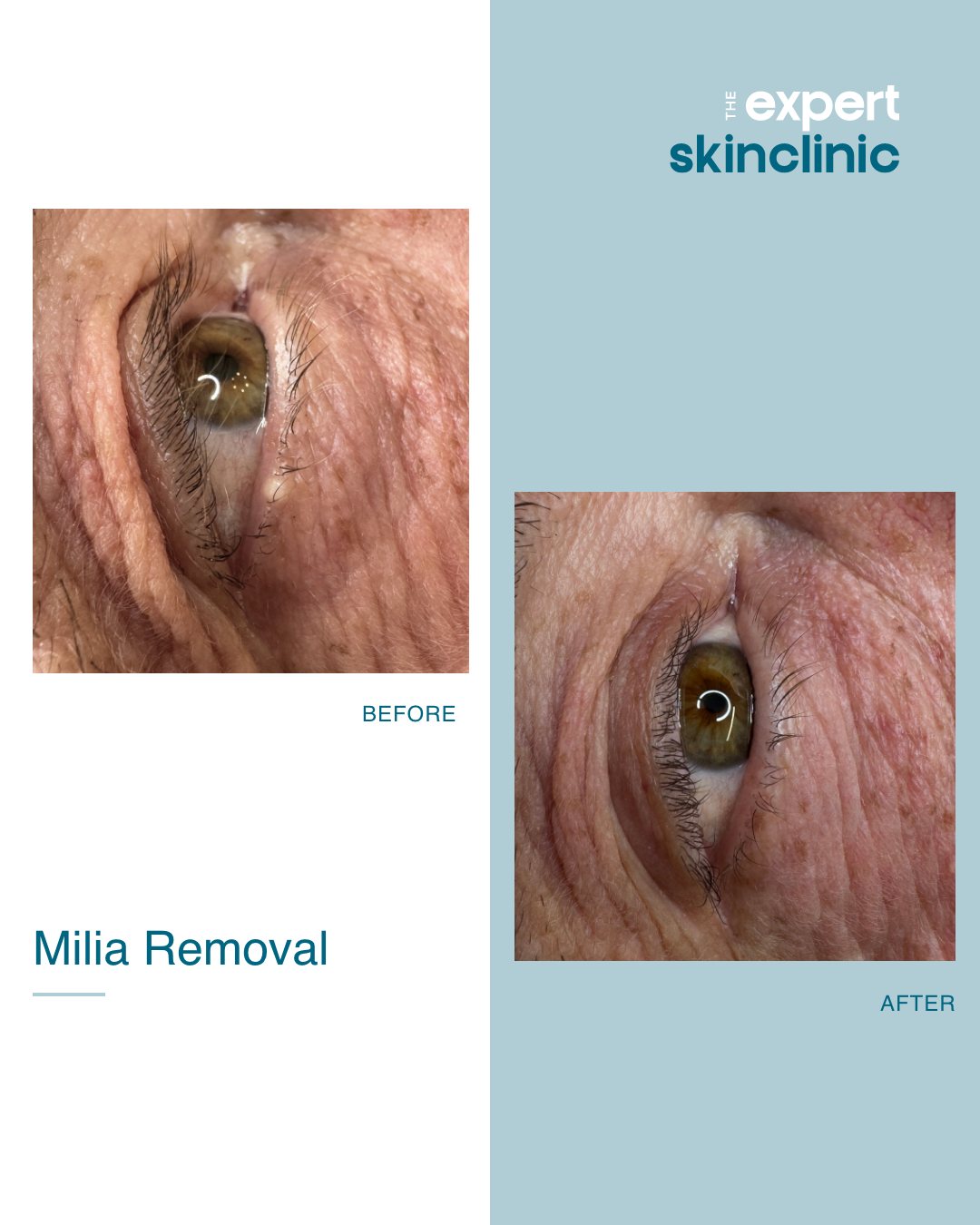 Tired of those small, white bumps around your eyes? This is called milia, which forms when keratin becomes trapped under the skin's surface, causing small white or yellow cysts.
They're harmless and will sometimes go away on their own, but can also be removed - even if in sensitive areas like this one right in the water line of the eye!
This fantastic result was achieved in just one sitting, using our specialist thermolysis pinpoint precision technique. This allowed us to safely work close to the eye for effective milia removal. After just 6 weeks, you can't even see where the milia once was and the client is very happy!
Visit our website to book a skin blemish consultation where we'll come up with a treatment plan💙
#milia #miliaremoval #thermolysis #skinhealth #precisionskincare