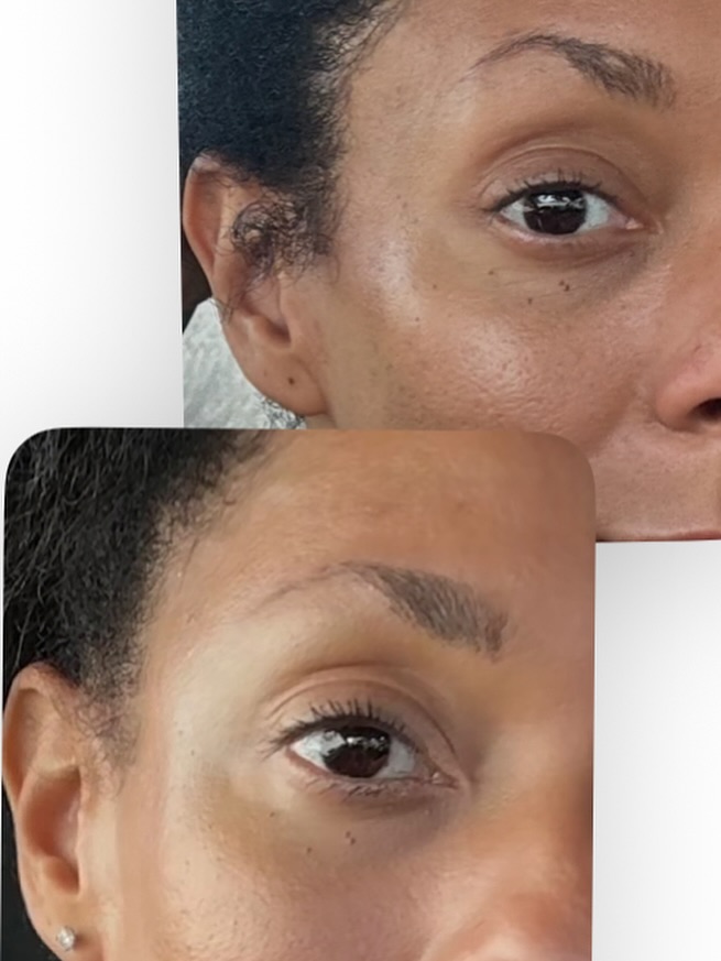 ✨ Temple filler glow-up with Radiesse + Belotero ✨
Lift, contour, and restore volume where it matters most.
💰 $900
⏰ 15-minute treatment
❤️