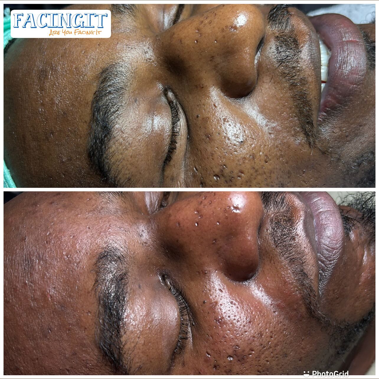 Get Into My Facials 🤗😊
Have your face cleanse with a facial massage while my warm mist hits your face. Let my hydro jell mask soak into your pours and open up your face. Check out my website and book an appointment at
AubriafacingIt.com
Ig page ➡️ @_FacingIt
#dermaplaningfacials #facialatlanta #atlantaspa #metroatlanta #clearskin #explorepage #vacuumtherapy #facials #lymphaticdrainage #Southsideatlantaspa #blackesthetician #atlantasouthside #Atl #beautiful #facialsatl #spaday #medspa #dayspa #hairremoval #aesthetics #facialtreatment #blackowned #estheticianatlanta #facingit #extractions #atlanta #naturalskincare #blackheadremoved #hydrafacial #skintherapis
Category Is 👉🏽 SELF CARE 💆🏽♀️. Ladies & Men I see you all taking that time to get your self care needs on. Try adding on FACIALS to your daily, weekly, monthly routine. Facials are good for the skin the help keep the skin hydrated,exfoliated, clear, & smooth. Come and get your relaxing self care needs from facials,body Contouring,and v-steams here at a peaceful location. Go to 👉🏽 aubriaFacingIT.com and check out pictures and services. Follow my IG @_Facingit
Fun Facts👉🏽 “each inch of skin is made up of 19 million skin cells, 650 sweat glands, 20 blood vessels, and 1,000 nerve endings, according to the” American Academy of Dermatology (AAD). Who wouldn’t knew 🧐 The cleansing of the skin is one of the most important benefits of the facial. Face massages and facials will help you accelerate the cell regeneration process. It will also increase the production of collagen under your skin. It will help you get younger skin and reduce the signs of stress. Follow my Ig➡️ @_FacingIt