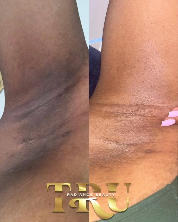 I thought you said you wanted to lighten your discoloration in your intimate areas? Well, why you haven’t booked yet??
Underarm Intimate Bleaching!
Results after 3 treatments !
#cincinnatiesthetician #cincinnatiintimatebleaching