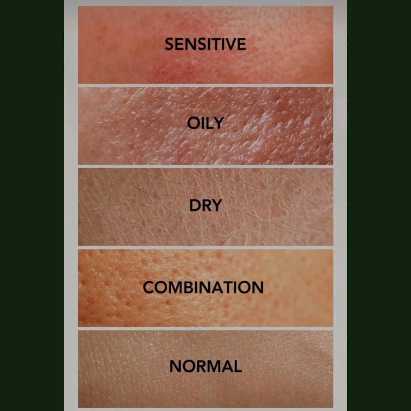 🧖♀️ How to Know Your Skin Type? 🧴✨
Understanding your skin is the first step to proper care! 💡
Look closely — do you recognize your skin in one of these?
🔸 Sensitive – easily irritated, redness, reacts to products
🔸 Oily – shiny, enlarged pores, prone to breakouts
🔸 Dry – flaky, rough, feels tight
🔸 Combination – oily in T-zone, dry or normal elsewhere
🔸 Normal – balanced, smooth, rarely breaks out
Want a free skin analysis? Text me to book your consultation at LNO Boutique and let us help you glow! 🌿✨
📲 DM to book | 📍Located in Centennial
#SkinCareTips #KnowYourSkin #FacialCare #LNOcare #GlowingSkin#lno_boutique#facialdenver
#facialmassage #facialcentennial
