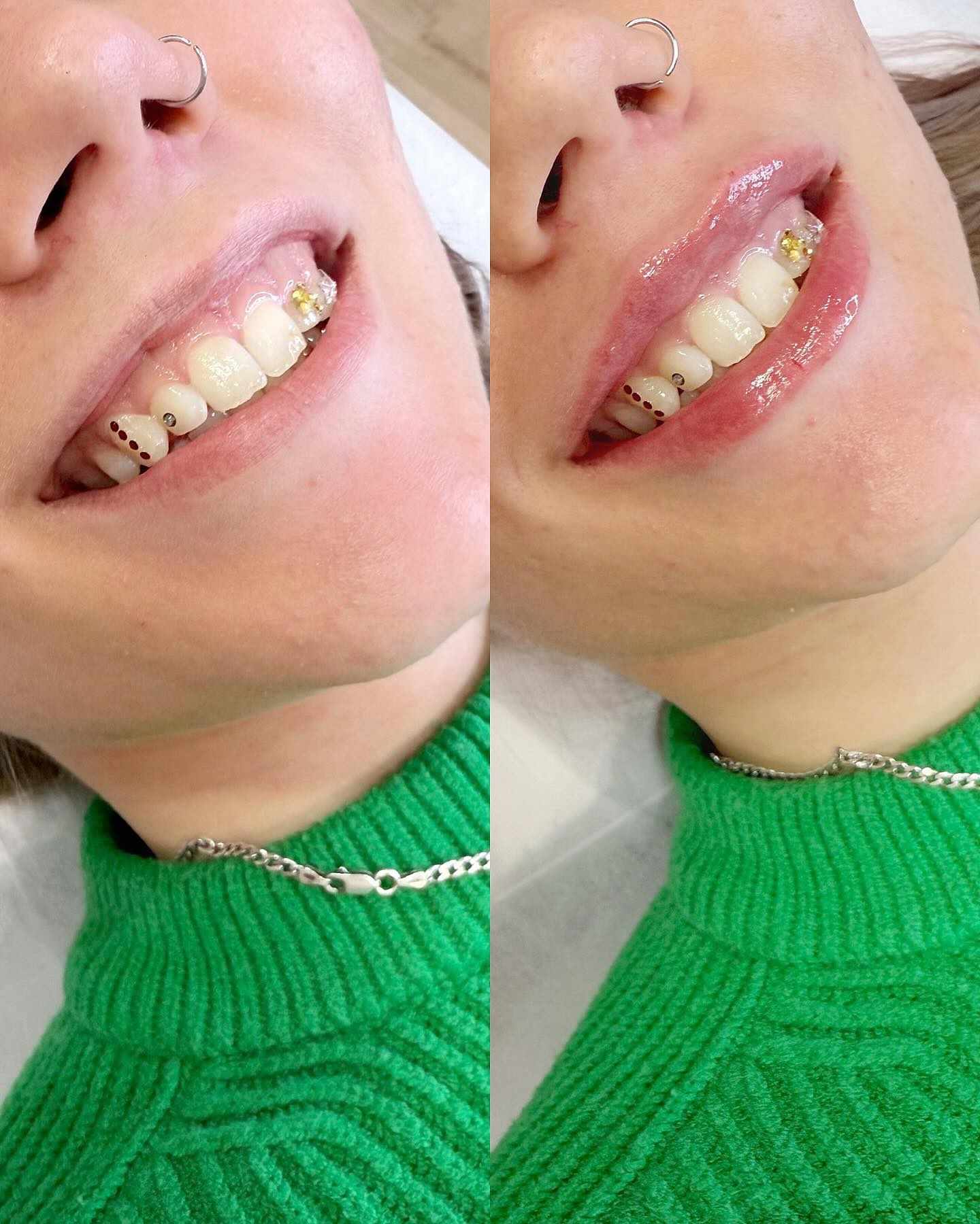 Luonnollista muutosta huuliin täyteaineen avulla. 💋