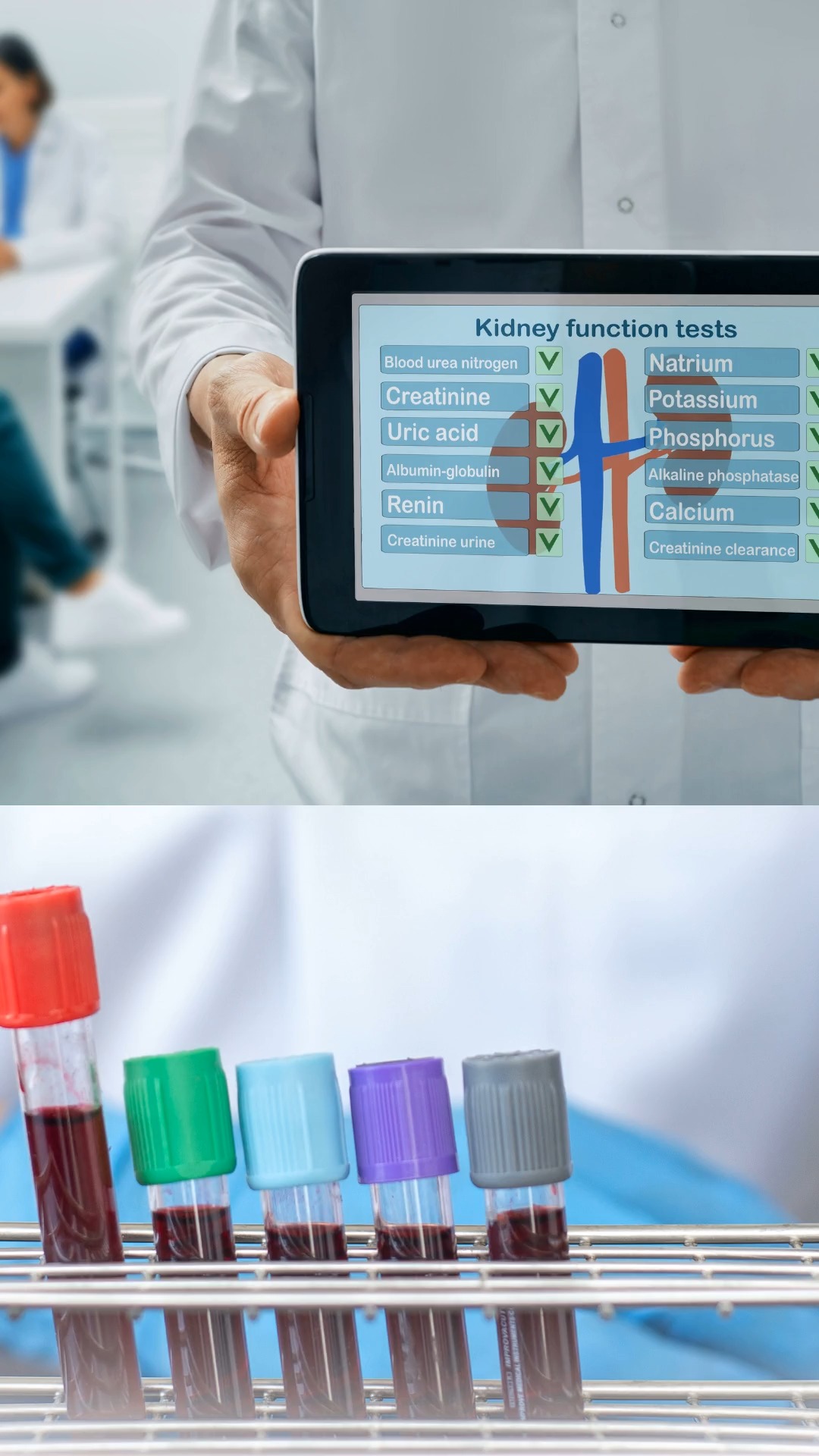 YOUR KIDNEY PROTECTION ACTION PLAN:
Step 1: GET TESTED PROACTIVELY
Don't wait for your doctor to suggest it. Request both eGFR (blood test) and urine albumin creatinine ratio (urine test). These aren't always included in routine blood work unless you ask.
Step 2: KNOW YOUR NUMBERS
Learn your kidney numbers like you know your blood pressure:
eGFR target: >90
uACR target: <30mg/g
Write them down. Track them over time.
Step 3: TRACK TRENDS
Single values can fluctuate, but trends over time tell the real story. Stable numbers = good news. Declining trends = need immediate attention.
SAVE THIS POST if you found it helpful and SHARE with someone who needs to see this.
QUESTIONS? Drop them below—I read every comment.
➤ For more kidney health insights: Follow @seanhashmimd
References
KDIGO 2022 Clinical Practice Guideline for the Evaluation and Management of Chronic Kidney Disease:
Recommends routine screening for eGFR and UACR in at-risk individuals
Emphasizes trend monitoring over time for both markers
(Kidney Int. 2022;101(5S):S1–S276)
National Kidney Foundation (NKF) – GFR and Albuminuria Categories:
Defines eGFR ≥90 ml/min/1.73 m² as normal and UACR <30 mg/g as normal albumin excretion
Promotes early detection with both tests
(www.kidney.org/professionals/guidelines/gfr_albuminuria)
Vassalotti JA, Centor R, Turner BJ, et al. "Practical approach to detection and management of chronic kidney disease for the primary care clinician."
Am J Med. 2016 Feb;129(2):153–162.e7.
Highlights that many CKD cases are missed due to lack of routine eGFR/UACR testing
Coresh J, et al. “Prevalence of Chronic Kidney Disease in the United States.”
JAMA. 2007;298(17):2038–2047.
Documents underdiagnosis due to absence of routine testing
Levey AS, Inker LA, et al. “GFR Decline as an End Point for Clinical Trials in CKD.”
Am J Kidney Dis. 2014;64(6):821–835.
Medical Disclaimer: This content is for educational purposes only and does not constitute medical advice. Always consult your healthcare provider for medical decisions.
#KidneyHealth #PreventiveMedicine #HealthScreening #MedicalAdvice #KnowYourNumbers #seanhashmimd #Nephrology #HealthTips #MedicalFacts #PreventiveCare
