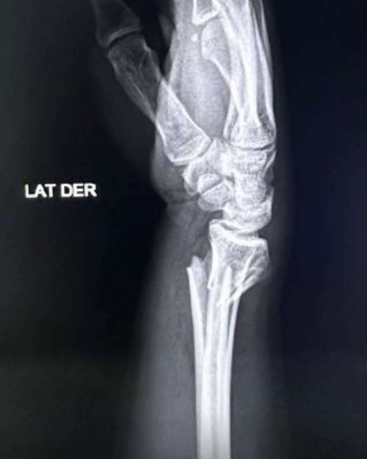 Fractura de radio distal tratada con reducción abierta y fijación con osteosintesis.
Las fracturas de radio distal son comunes en caídas de propia altura en pacientes con osteopenia/ osteoporosis sin embargo en ocasiones puede presentarse en traumatismos de alta energía en pacientes jóvenes.