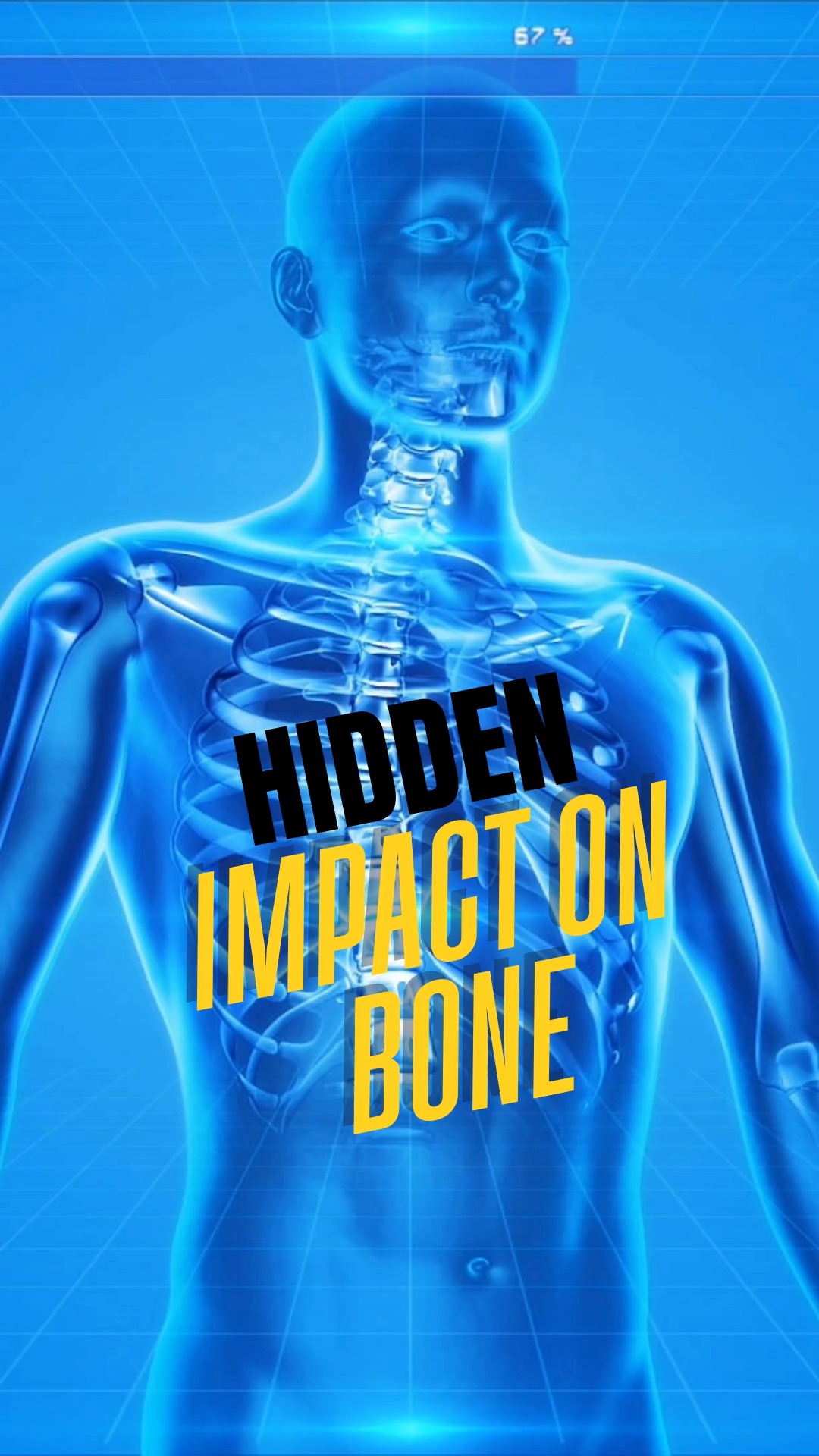 Why kidney disease affects your entire body
WHAT MOST PEOPLE DON'T KNOW:
Kidney disease isn't just about waste removal—it disrupts your entire body's chemical balance.
THE BONE CONNECTION:
When kidneys can't filter phosphorus or activate vitamin D properly, you get:
Bone pain and weakness
Severe itching
Muscle cramps
Calcium deposits in blood vessels (↑ heart attack risk)
THE SODIUM PROBLEM:
Damaged kidneys can't excrete excess sodium, leading to:
Fluid retention and swelling
Worsening high blood pressure
Heart strain
SAVE THIS POST if you found this insight helpful and SHARE with someone managing kidney concerns.
QUESTIONS? Drop them below—I read every comment.
➤ For more kidney health insights: Follow @seanhashmimd
📚 References:
Mineral and Bone Disorders in CKD:
KDIGO (2017). CKD–Mineral and Bone Disorder (CKD–MBD) Guidelines.
Moe, S., et al. (2006). Definition, evaluation, and classification of renal osteodystrophy: a position statement from Kidney Disease: Improving Global Outcomes (KDIGO). Kidney Int, 69(11), 1945–1953. https://doi.org/10.1038/sj.ki.5000414
Phosphorus and Calcium Imbalance:
Martin, K. J., & González, E. A. (2007). Metabolic bone disease in chronic kidney disease. J Am Soc Nephrol, 18(3), 875–885. https://doi.org/10.1681/ASN.2006070795
Vitamin D and Secondary Hyperparathyroidism:
Holick, M. F. (2007). Vitamin D deficiency. N Engl J Med, 357(3), 266–281. https://doi.org/10.1056/NEJMra070553
Vascular Calcification and Cardiovascular Risk:
London, G. M., & Drueke, T. B. (2004). Atherosclerosis and arteriosclerosis in chronic renal failure. Kidney Int, 66(2), 448–456. https://doi.org/10.1111/j.1523-1755.2004.761_2.x
Sodium Retention and Edema:
Schrier, R. W. (2010). Body fluid volume regulation in health and disease: a unifying hypothesis. Ann Intern Med, 113(2), 155–159. https://doi.org/10.7326/0003-4
Medical Disclaimer: This content is for educational purposes only and does not constitute medical advice. Always consult your healthcare provider for medical decisions.
#KidneyHealth #ChronicKidneyDisease #BoneHealth #ElectrolyteBalance #KidneyBoneDisease #PreventiveMedicine #MedicalFacts #Nephrology #HealthEducation #seanhashmimd