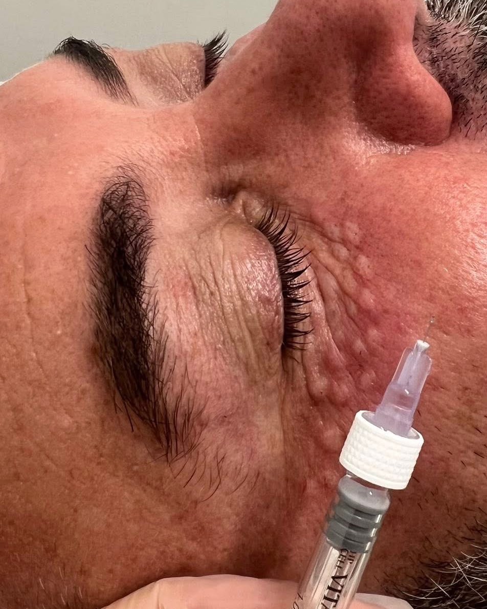 Dark circles? ๐ค Not on our watch!
Polynucleotides work deep - repairing the skin, boosting collagen and brightening where concealers fail us!
No filler. Just fresh under eyes ๐
Polynucleotides for under eyes - only ยฃ99 special offer at The Beauty Lab North East, Felling!
Want to book yours?
Click the direct link to polynucleotides below and let us help you look as rested as you wish you felt ๐ค๐
#salmondna #polynucleotides #polynucleotidesuk #aesthetics #gateshead #thebeautylabnortheast #aestheticsuk #FellingSalon #northeast