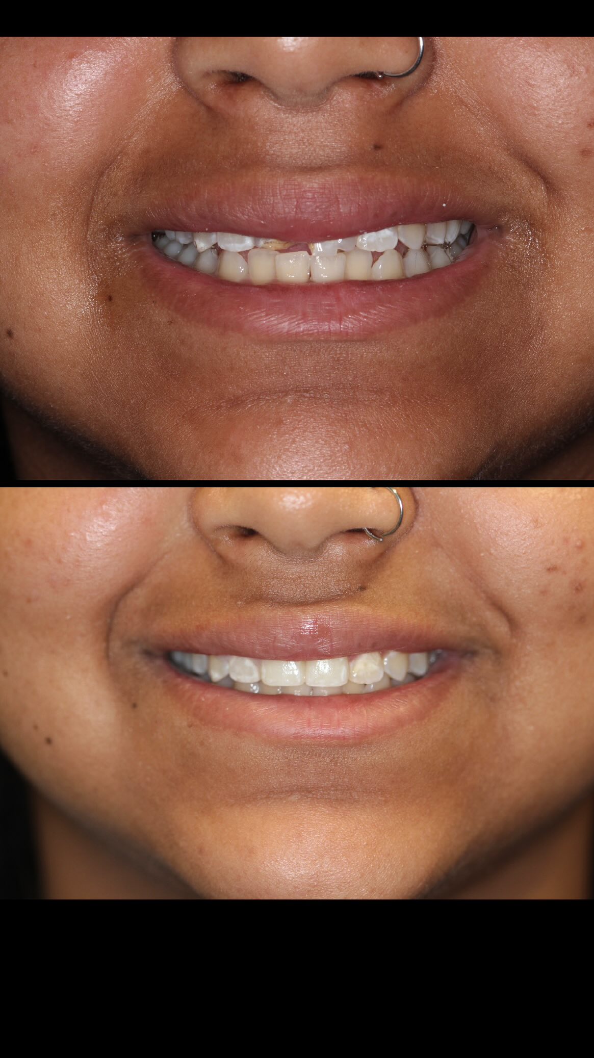 From hesitant to radiant. Crowns gave her the smile—and confidence—she deserves! #instantaura #aura #orlandodentist