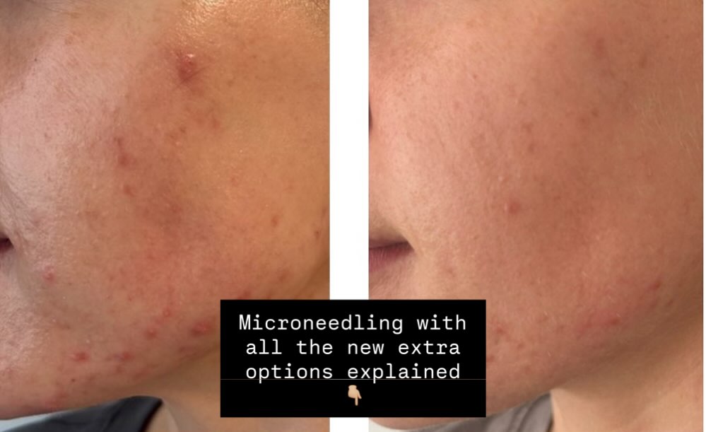 SO MANY OPTIONS 😜😜😜🤪🤪🤪
There are so many ways to boost your microneedling outcome, but it can be overwhelming. Pick 1 or 2 or all three for best results. Pros of each explained below 👇🏼
🧬 Exosomes or Salmon DNA Microneedling vs. Sculptra and microneedling:
Let’s break down two powerful ways to boost collagen and improve skin — inside and out.
✨ Microneedling + Exosomes or Salmon Sperm (DNA)
• Repairs & regenerates skin at the cellular level
• Brightens, smooths, and deeply hydrates
• Ideal for texture, acne scarring, and overall glow
• Salmon DNA = rich in polynucleotides (the good stuff for skin renewal)
💉 Sculptra with microneedling
✨ Benefits
Improves skin firmness, elasticity, and thickness
• Targets fine lines, texture, and crepey skin
• Creates a natural, subtle tightening effect
• Less volume than injected Sculptra — ideal for someone not wanting “filler”
• Can be used on the face, neck, chest, and body
⸻
🗓️ Best For:
• Early signs of aging or skin laxity
• Patients looking for subtle rejuvenation
• Those who want to avoid injectables but still want collagen stimulation
• Great maintenance for those who’ve had Sculptra injections in the past
🆚 The Difference?
Microneedling gives you surface glow and skin health.
Sculptra gives structure and volume from within.
✅ And yes… you can combine both strategically for max results.
✨ Want to know what’s right for your skin goals? DM or book a consult — we’ll build your custom plan.
#Microneedling #Exosomes #Sculptra #SkinRejuvenation #CollagenBoost #Polynucleotides #FacialAesthetics #SkinGlow #SalmonDNA #ShiftStudioAesthetics