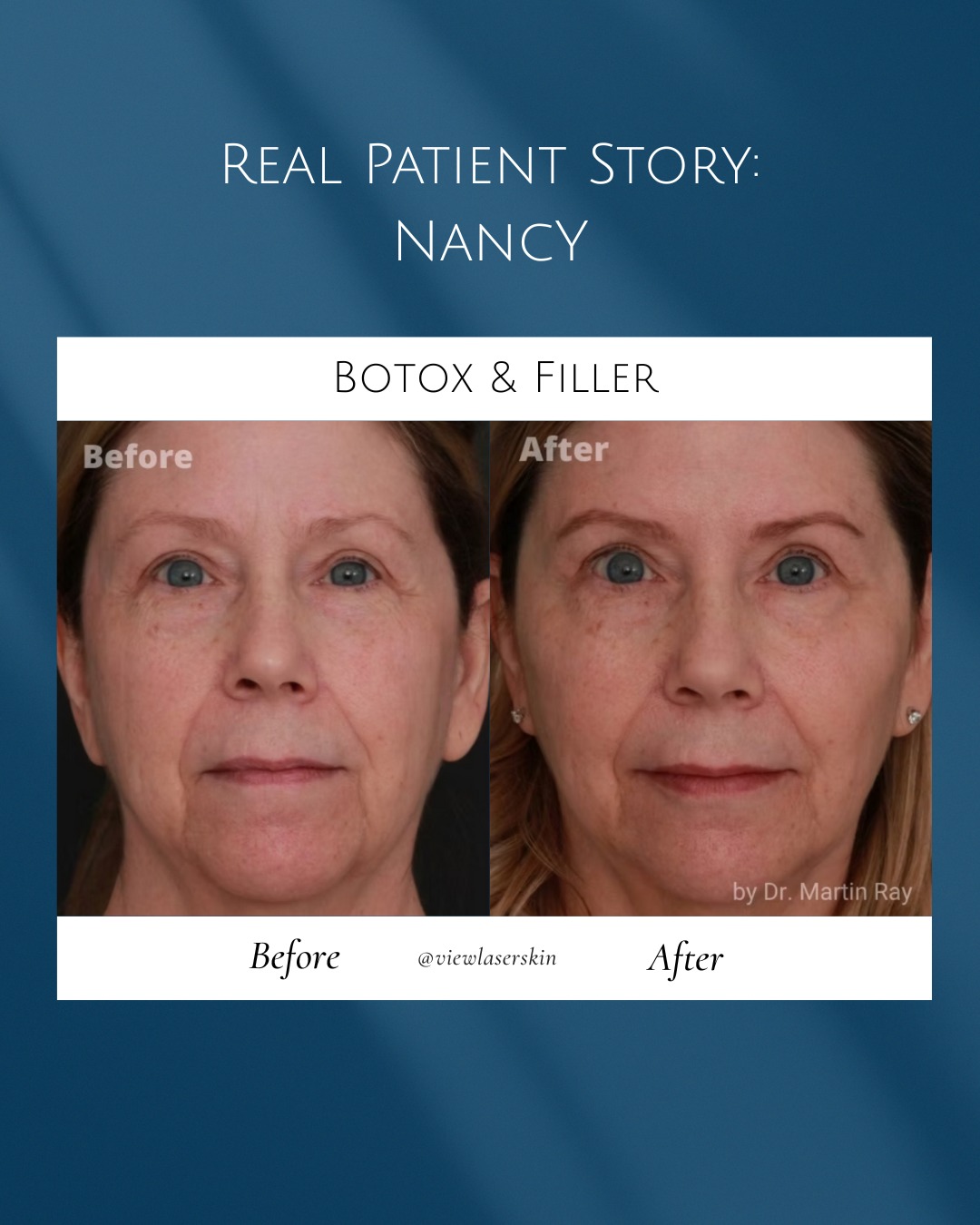 When Nancy came to View Laser, she was feeling the effects of stress and loss — and she felt it showed in her reflection. She was looking for a non-invasive way to look less tired.
Dr. Ray created a comprehensive, personalized treatment plan that included Botox and dermal filler to restore volume, symmetry, and softness to Nancy’s face, without drastically changing how she looked.
The result? A natural, balanced refresh that gave her a boost of confidence and inspired a whole new approach to skincare.
Book a consultation to learn what’s possible for you!
#ViewLaser #DermalFiller #FacialBalancing #AestheticMedicine #Juvederm #Botox