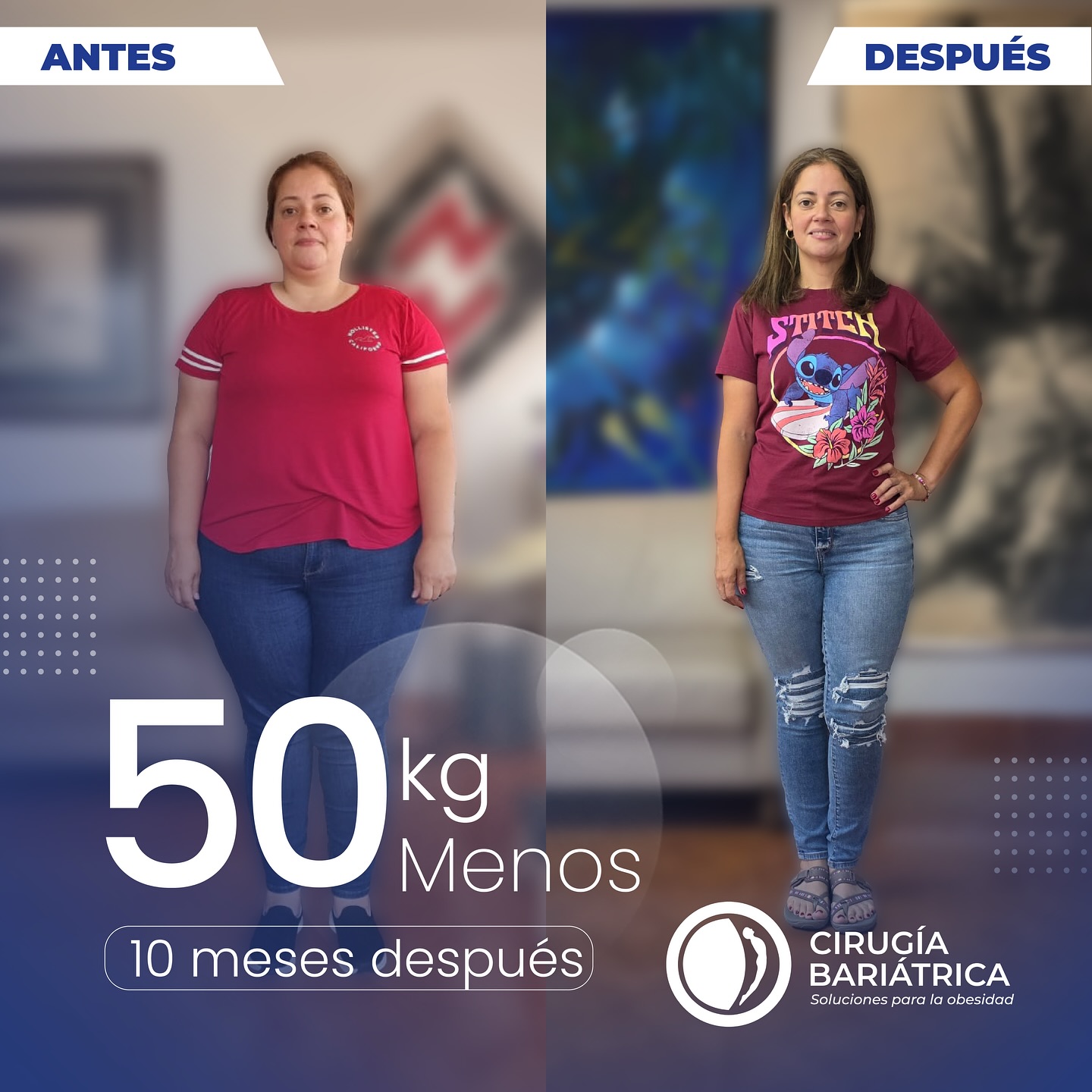 ¡50 kg menos y una vida llena de nuevas posibilidades! 💫
En solo 10 meses, nuestra valiente paciente ha transformado su salud, confianza y felicidad gracias a la cirugía bariátrica realizada por el Dr. Eduardo Bolaños y su equipo.
Más que kilos perdidos, son sueños recuperados, energía renovada y una nueva oportunidad de vivir plenamente.
¡Felicidades por este increíble logro! 🩺❤️
50 kg lost and a life full of new possibilities! 💫
In just 10 months, our brave patient has transformed her health, confidence, and happiness thanks to bariatric surgery performed by Dr. Eduardo Bolaños and his team.
More than weight lost, it’s about regained dreams, renewed energy, and a new chance to live life to the fullest.
Congratulations on this incredible achievement! 🩺❤️
#bariatric #bariatricsurgery #gastricbypass #bypassgastrico #health #healthy #healthandwellness #healthyliving #weightlosssurgery #weightlossjourney #weightlosstips #happiness