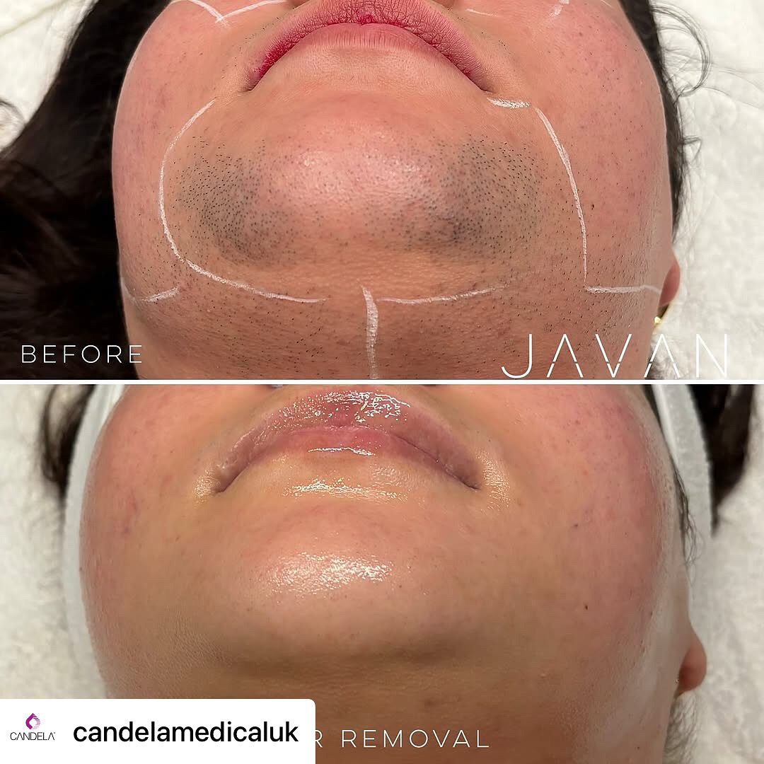 We just had to repost this amazing transformation using Candela laser hair removal! 😍✨
While these results are from another incredible clinic, we use the same industry-leading technology — the Candela Alexandrite 755nm laser — right here at @laserwaylisburn
💥 This could be YOU!
Say goodbye to unwanted hair with safe, effective, and life changing treatment
📩 Message us today to book your FREE consultation and patch test!
Original post @candelamedicaluk
Check out these amazing results from @skindollbre and @javanwellness with the GentleMax Pro!
“Hormonal hair growth is one of the hardest things to treat, Polycystic Ovary Syndrome (PCOS) is a hormonal imbalance where the ovaries produce excess androgens (male hormones), this can lead to excess hair growth.
This patient saw many other providers at different practices, tried different lasers and saw no improvement. Hearing the words “you changed my life” is EXACTLY why I do what I do”- @skindollbre
📸 @Javan wellness @skindollbre