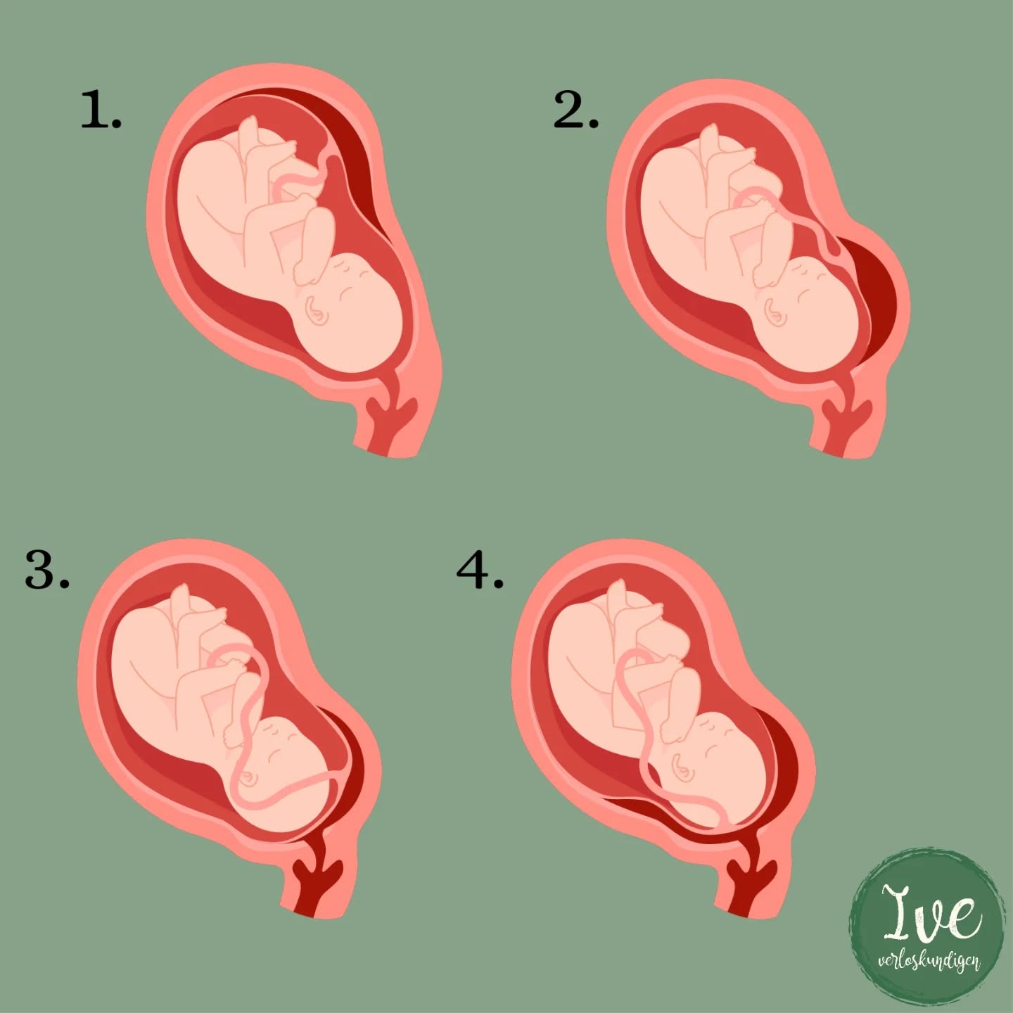 Wij krijgen regelmatig de vraag na de 20 weken echo 'de placenta ligt voor, geeft dit problemen voor de bevalling?' We snappen die vraag! En uitleggen doe ik meestal door een tekening te maken, want dan volgt een 'oooo, ik snap het'.
Dus vandaag post 1 van 2 over de ligging van de placenta 😁. Hij kan namelijk op heel veel plekken zitten, maar grofweg is hij op 4 plekken te onderscheiden.
1. Voor of achter
2. Laagliggend
3. Slip over de baarmoedermond
4. Volledig over de baarmoedermond
1. Op afbeelding 1 ligt de placenta aan de achterzijde, wat betekent aan de rug kant van moeder. Hij kan ook op de voorwand liggen, we zeggen dan de placenta ligt voor, maar eigenlijk bedoelen we dan de buikzijde van moeder. Het maakt niet uit of hij aan je buik- of rugzijde ligt. Beide situaties zijn compleet normaal. Wel kan het zijn dat als je placenta voor ligt, je je kindje wat later in de zwangerschap voor het eerst voelt bewegen.
2. Deze placenta is laagliggend en ligt binnen 2 cm van de baarmoedermond. Dat komt bij 20 weken regelmatig voor en is op zichzelf dan nog geen reden om de gynaecoloog mee te laten kijken. Wel controleren we bij 32 weken of hij nog steeds binnen 2 cm ligt of naar boven is 'getrokken'. Zie je baarmoeder als een ballon. Als je een zwarte stip zet op de ballon en je gaat hem opblazen (dus laat hem groeien), dan verplaatst het zwarte puntje zich meestal naar boven. De placenta zelf gaat dus niet ineens ergens anders groeien of verschuiven, maar wordt door de groei van je baarmoeder mee naar boven getrokken.
Wij vinden placenta's altijd heel interessant, het is het orgaan dat jullie kindje laat groeien❤️.
Afbeelding 3 en 4 bespreken we in een volgende post! 🤩
#verloskundige #verloskundigen #placenta #verloskundigenpraktijk
#verloskundigewaddinxveen #zwangerschap #zwanger #bevalling #verloskundigekoningskwartier