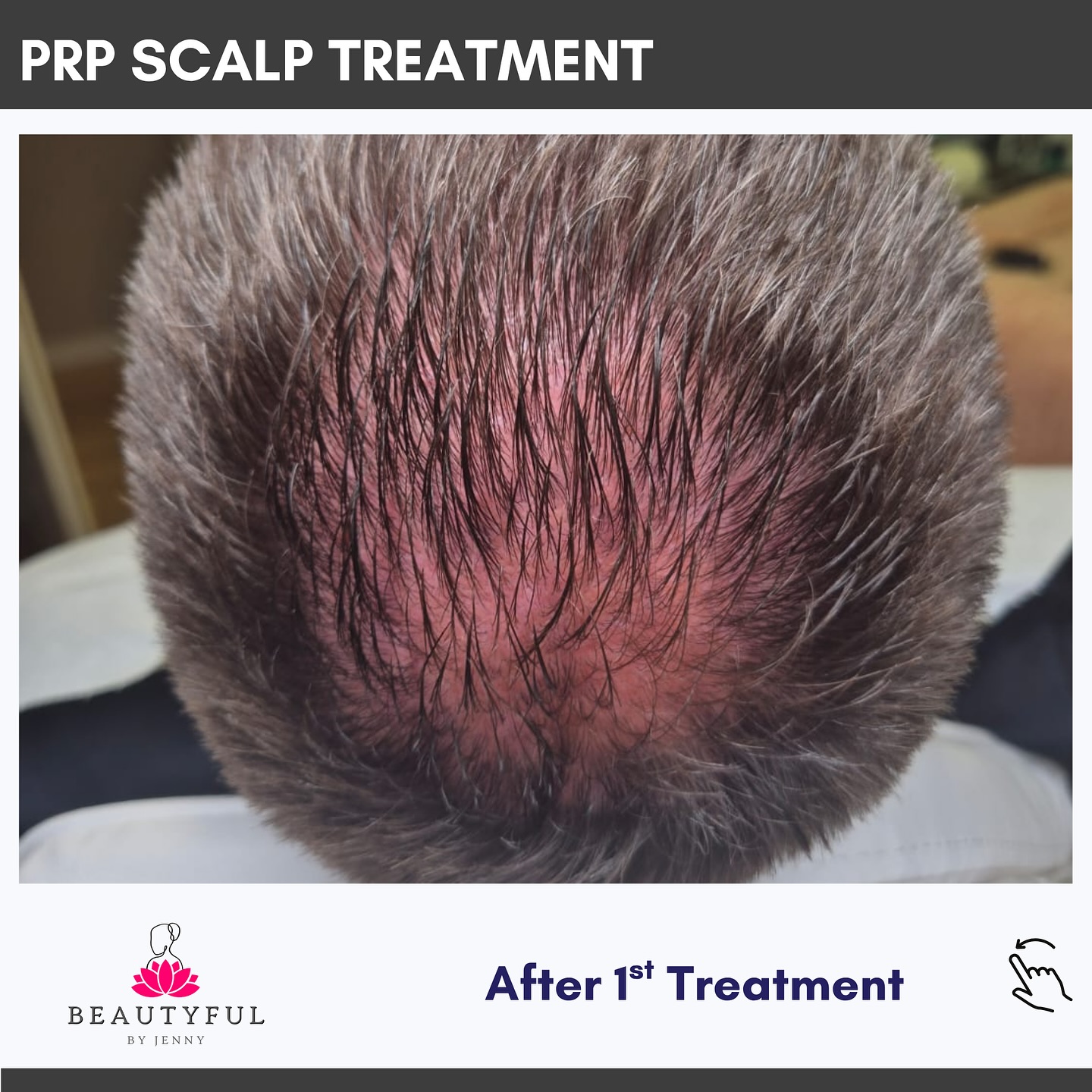 โจ Hair transformation! โจ
PRP Scalp Treatment is changing the game for both men and women dealing with thinning hair, receding hairlines, or patchy spots.
Swipe to see these real results after just 3 sessions, my client is already seeing amazing growth and renewed confidence! ๐โโ๏ธ
This is a revolutionary treatment backed by science, and right now, you can save with discounted packages when you book a course.
The perfect confidence boosting gift for yourself or someone you love.
DM to book or learn more ๐๐ฉธ๐โโ๏ธ