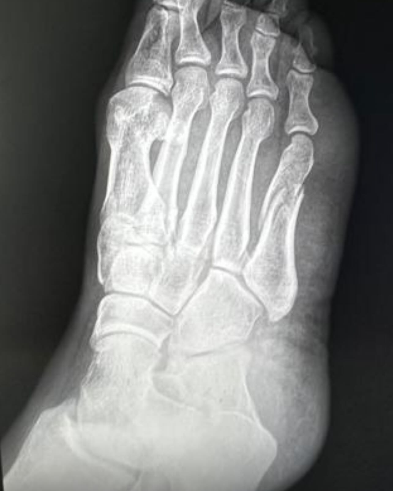 Las fracturas de los huesos metacarpianos son lesiones que condicionan dolor intenso e incapacidad para poder caminar, si existe una angulacion o desplazamiento importante de los fragmentos debe ser tratada mediante cirugía.