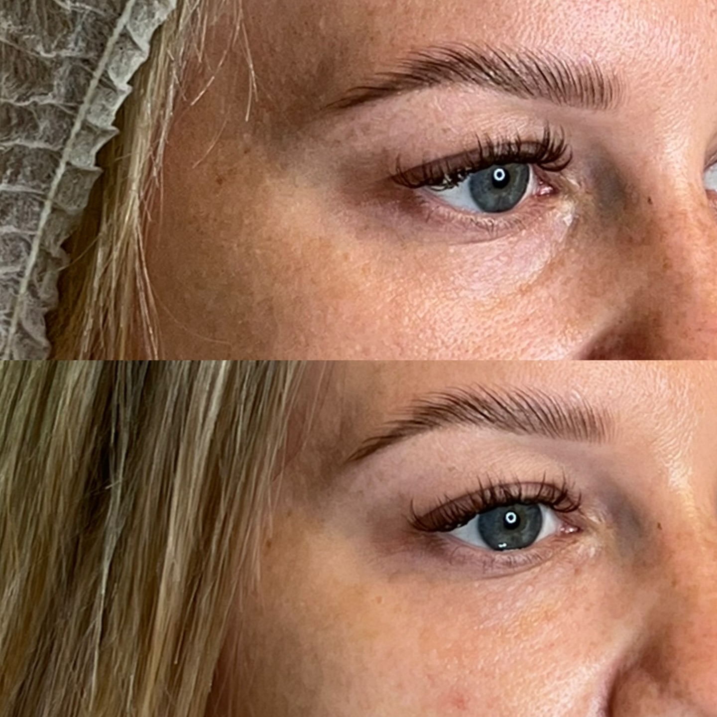 ✨ Avant / Après injection cernes ✨
Les injections d’acide hyaluronique au niveau des cernes permettent d’atténuer l’aspect creusé et fatigué du regard.
Ici, une correction douce a été réalisée à la canule, une technique sécurisée qui permet de limiter les risques de bleus et d’atteinte des vaisseaux.
Attention, cette indication ne convient pas à tout le monde. Elle dépend de la structure du cerne, de la peau, et de l’anatomie de chacun.
Dans ce cas précis, l’injection était indiquée car le cerne était marqué mais sans poches associées.
Un devis personnalisé est toujours réalisé en consultation avant toute injection.
Résultat immédiat, naturel et sans éviction.