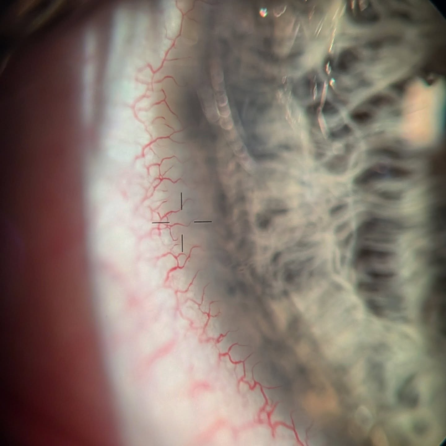 Fun fact: the clear part of the eye (the cornea) is meant to be clear 🤯
Sleeping in contacts, over wearing contacts or wearing contacts incorrectly causes blood vessels to creep into the cornea and can cause big (sometimes painful) trouble 😵💫
#usedontabuse #contactlenscare #lecturelife #newbergfamilyeyecare #newbergeyes #sherwoodeyes #maceyes #travelingeyedoc
