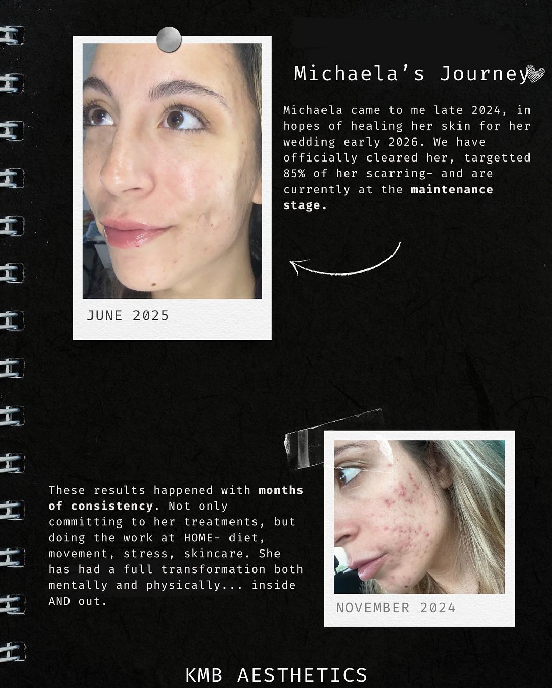 My sweet Michaela 💖
Clients like you make my “job” so easy. Here’s a real look at the process of healing acneic skin. It takes 2 and it takes commitment, but it’s always possible.
At KMB I pride myself on finding the root cause to target specific skin concerns, providing my clients with all the guidance necessary to be successful in healing. ❤️🩹
#browardesthi #browardesthetician #browardfacials #browardskincare #browardacne #browardacnespecialist #miamifacials #miamiesthies #miamiskincare #esthiebestie #esthischool