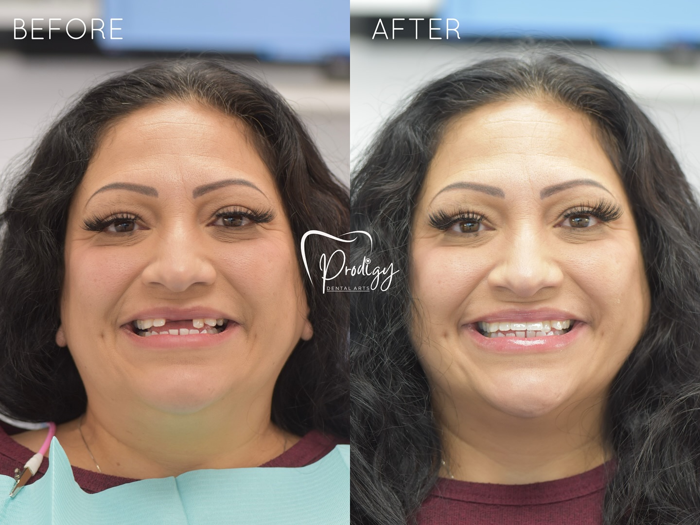 Before ➡️ After 🦷✨
A beautiful, confident smile — restored with dental implants!
They don’t just look natural — they feel and function like real teeth.
Ready for your own transformation?
📩 DM us to book your consultation!
#DentalImplants #SmileTransformation #BeforeAndAfter #ConfidenceBoost #HealthySmile #ImplantDentistry