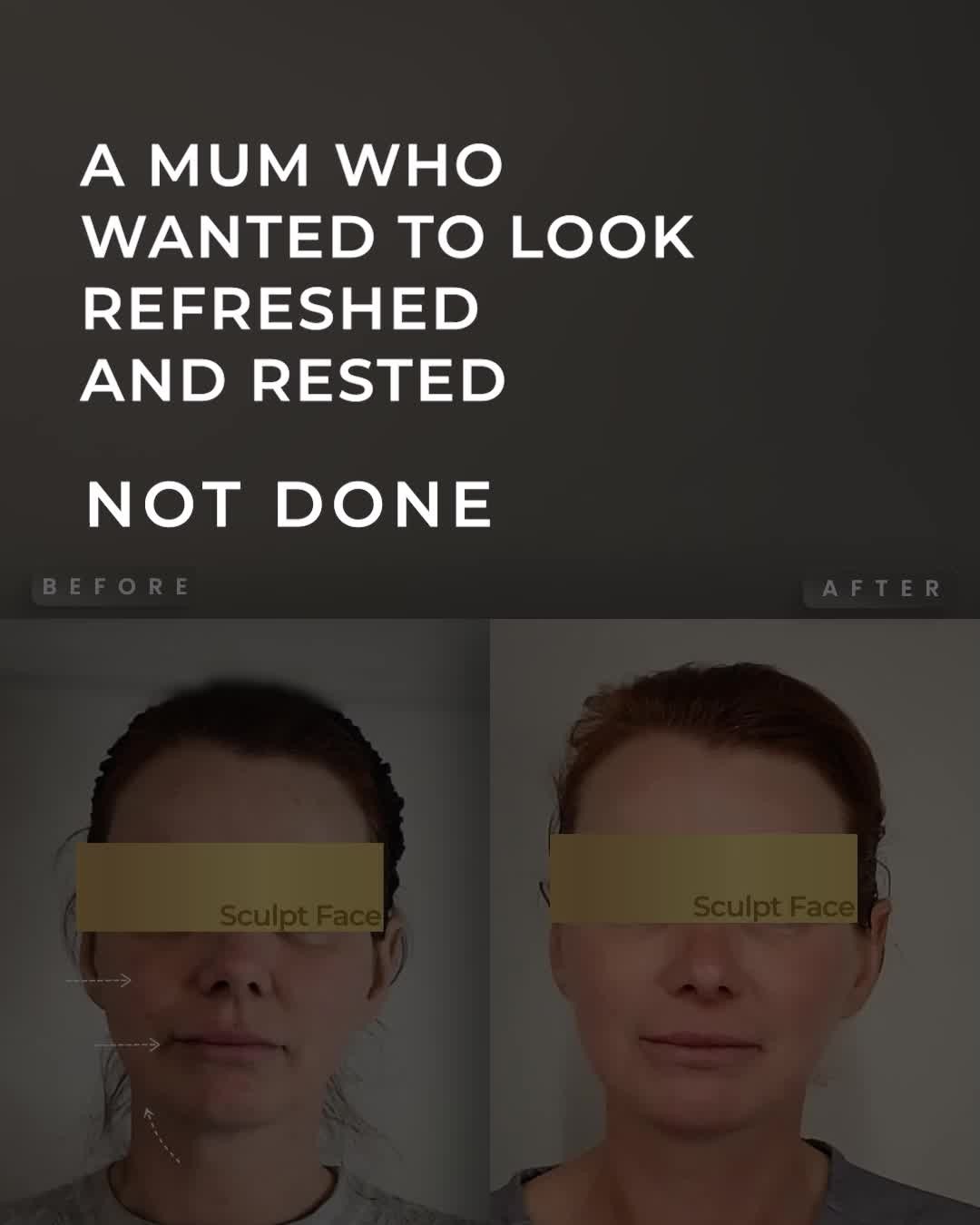 She’s a young woman balancing the weight of motherhood and a demanding career.
She wanted her reflection to show the same zest for life she felt inside.
Not just the exhaustion.
Not a different face.
Using the Sculpt Face Protocol™, Dr. Sam focused on gentle lifting and deep skin renewal.
Tailored precisely to her features.
The result:
🔸 A brighter tone
🔸 Smoother texture
🔸 A fresher, more even complexion
🔸 Softened the lines of stress
🔸 Subtle lifting
Full face rejuvenation that feels subtle, natural and balanced.
#SculptFace
#SculptFaceProtocol
#EndoliftUK
#endolift
#endoliftlaser
#endolifting
#endolifttreatment
#endoliftingfacial
#NonSurgicalFacelifts
#SkinRejuvenation
#SkinGoals
#GlowFromWithin
#CollagenBoost
#SkinTightening
#SkinTighteningTreatment
#facialrejuvenation
#laserrejuvenation
#nonsurgical
#aesthetictreatments
#liverpoolaestheticsclinic
#manchesteraestheticsclinic
#leedsaestheticsclinic
#sheffieldaestheticsclinic
#greatermanchesteraesthetics
#cheshireaestheticsclinic