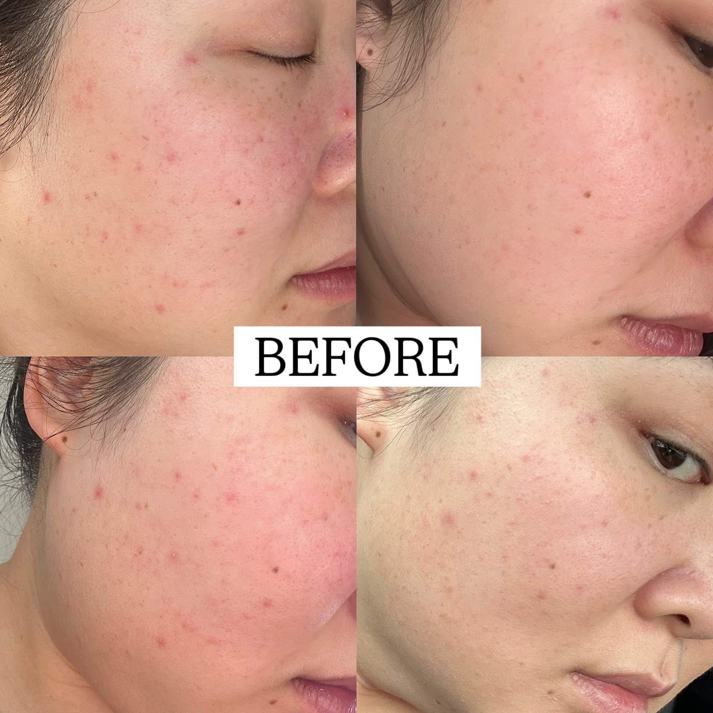 Do you ever catch yourself staring way too closely at your skin?
Zooming in on every little bump or spot, dry patch, or red flare-up - picking it apart, even when no one else would notice?
We’ve all done it. Most of us are way harder on ourselves than we’d ever be to anyone else. And when your skin suddenly changes, even when you’re doing everything ‘right’, it can really knock your confidence.
I get it, because I’ve been there recently too.
Before my holiday, I had a flare-up of redness that felt like it came out of nowhere. My skin looked calm to others, but underneath it felt reactive. I went back to basics, leaned into what I know works, and added AlumierMD Calm-R serum which made such a difference. It helped soothe the flare, reduce redness, and reminded me that skincare is never a straight line.
Whether your skin is breaking out, feeling tight and dry, or just a bit ‘off’ lately, we figure it out together. Just remember your skin doesn’t need to be perfect, it just needs support.
📍 Aylesbury, Buckinghamshire
📞 07759567391
📩 info@skinbycatherinemaria.com
🌍 www.skinbycatherinemaria.com
.
#aylesbury #aylesburybusiness #aylesburyvale #aylesburymums #aylesburybeauty #aylesburybeautysalon #aylesburytown #buckinghamshire #buckinghamshirebusiness #buckinghamshirewedding #buckinghamshiremums #buckinghamshirelife #buckinghamshirebeauty #fairfordleys #berryfieldsaylesbury #kingsbrookaylesbury #westonturville #stokemandeville #wendover #astonclinton #waddesdon #haddenham #longcrendon #skinbycatherinemaria #dermaviduals #dermaluxled