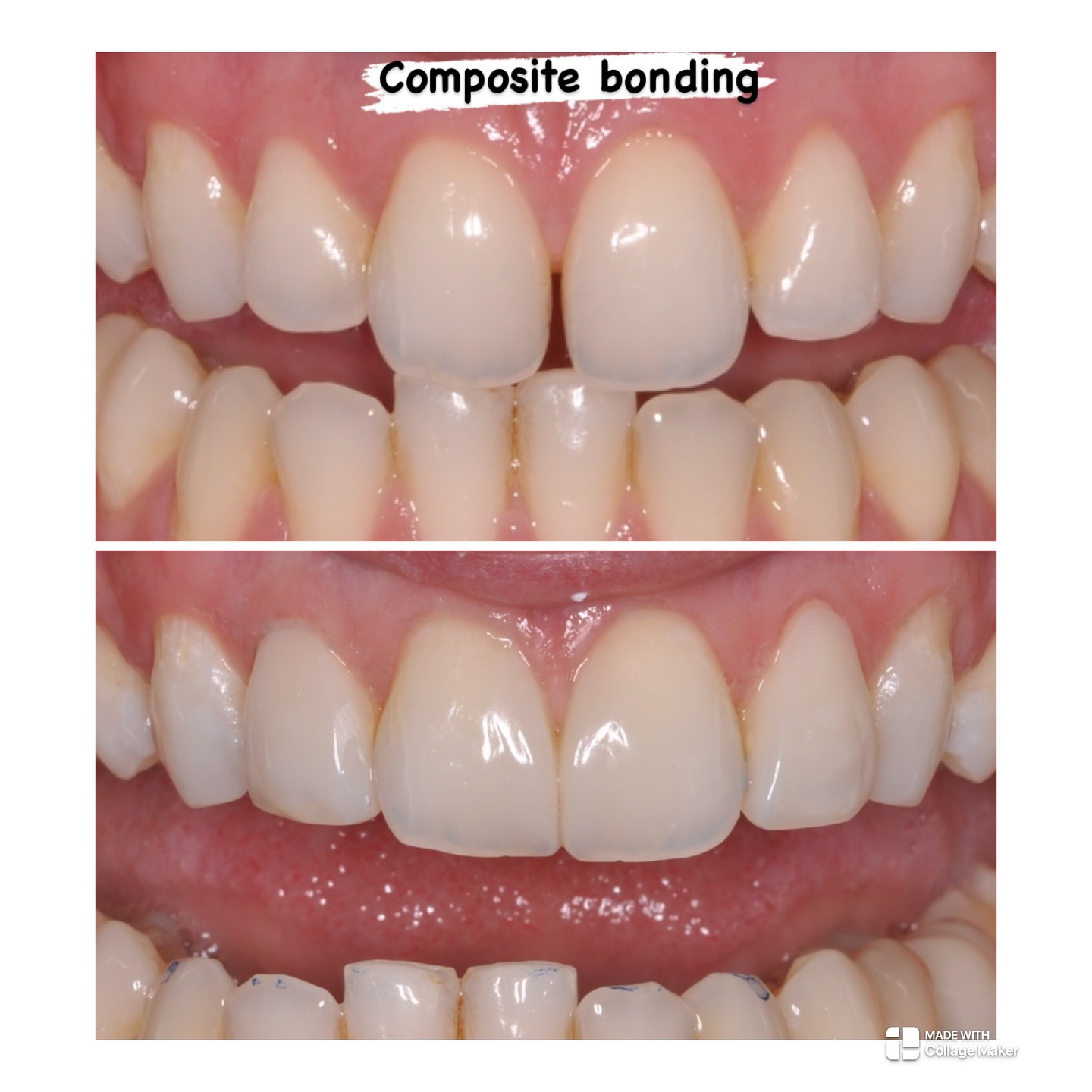 Composite bonding of upper incisors with closure of midline diastema and shaping upper laterals #dentistrylife #dentistrylove #dentallife #oralhealth #veneers #dentalhygiene #healthysmile #dentalhealth #dentures #dentallab #dentalschool #dentalassistant #endodontics #smilemakeover #dentistica #dentist #cosmeticdentist #dentistlife #ortheodontics #dental #funnydentist #dentistry #dentistlife #dentalclinic #dentalassistant #dentista #dentistica #dentistrylove #dentists #compositebonding