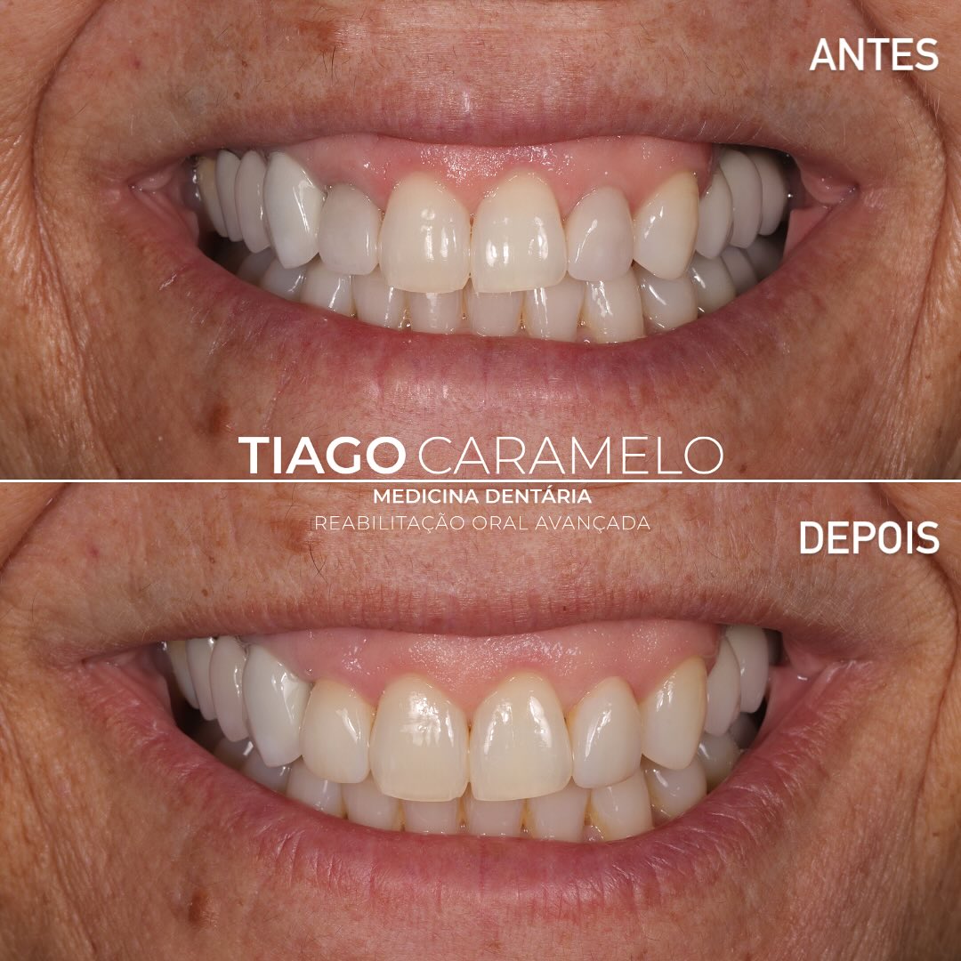 Porque aparecem sombras escuras à volta das coroas dentárias? 🔎
⠀
👉 No caso que partilho hoje, o halo escurecido na gengiva junto ao incisivo lateral devia-se sobretudo a um material cerâmico inestético e a um perfil de emergência pouco anatómico. Esta particularidade da estética anterior incomodava a paciente, que não se sentia confiante quando sorria.
⠀
👨⚕️ Qual foi a solução?
Redesenhámos as coroas com um perfil de emergência mais anatómico, respeitando o espaço biológico, ao mesmo tempo que utilizámos materiais cerâmicos mais estéticos. O resultado? Uma gengiva mais saudável, estética natural e sem zonas de sombra.
⠀
✅ Uma reabilitação dentária de excelência vai muito além da estética do dente — envolve também o equilíbrio com os tecidos moles e a biologia envolvente.
Trabalho cerâmico realizado por @anabelasilvacerqueira
—————————————————————————————
🔎 Why do dark shadows appear around dental crowns?
⠀
👉 In the case I’m sharing today, the dark halo on the gum near the lateral incisor was mainly due to an unaesthetic ceramic material and a poorly contoured emergence profile. This particular anterior aesthetic issue bothered the patient, who didn’t feel confident when smiling.
⠀
👨⚕️ What was the solution?
We redesigned the crowns with a more anatomical emergence profile, respecting the biological width, and used more aesthetic ceramic materials. The result? Healthier gums, a natural smile, and no more shadowing.
⠀
✅ A high-quality dental rehabilitation goes far beyond the appearance of the tooth — it also involves harmony with the soft tissues and the surrounding biology.
Labwork by @anabelasilvacerqueira
#dentalcrowns #smilemakeover #cosmeticdentistry #blackspot #gingivalhealth #emergenceprofile