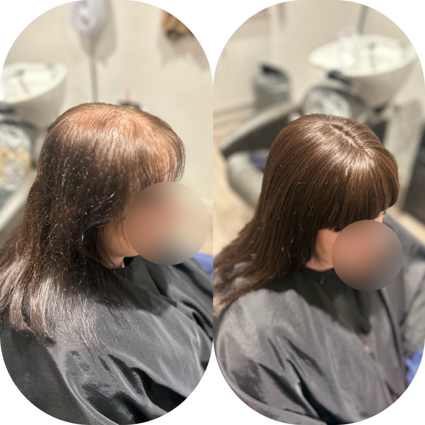 This amazing lady took the bold step to embrace an integrated hair system after years of dealing with hair loss, and the results are stunning!
Not only does it look incredibly natural, but even her young kids—who are known for their brutally honest opinions, gave their stamp of approval! 🥰👶 It just goes to show that sometimes, a little change can make a world of difference in how we feel about ourselves.
.
.
.
.
.
.
#lacetopwigs #lacefrontwigs #lacewigs #wigs #lacefrontal #alopecia #areata #hairloss #hairreplacements #bespokewigs #customcolouredwigs #handmadewigs #wigbuilding #hairintegration #laceintegration #hairextensions #weave #hairlossspecialist #trichologist #trichology #hairlosssolution #hairlosssalon #hair
#HairTransformation #NewBeginnings #ConfidenceInEveryStrand