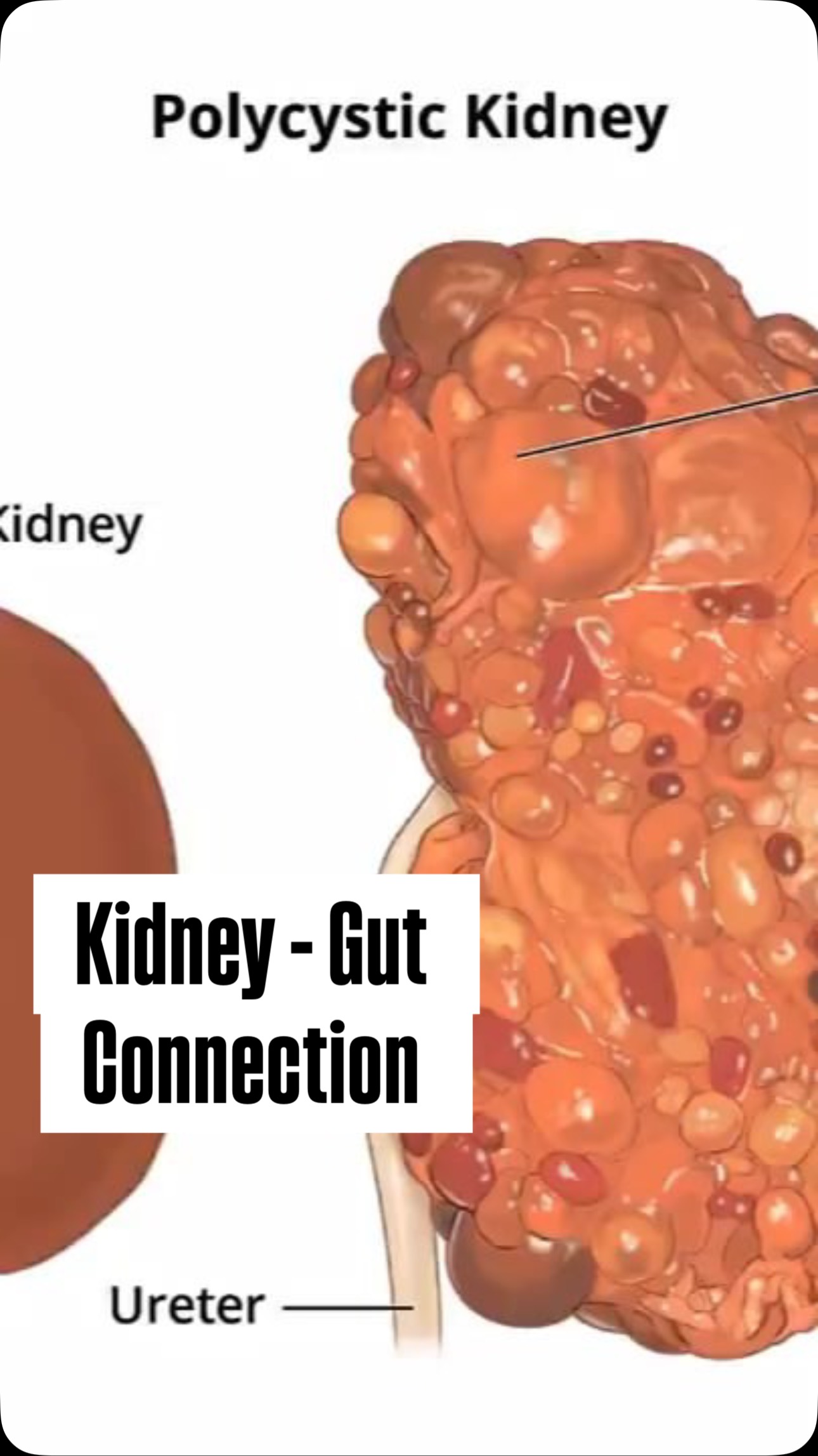 Kidney-Gut Connection Destroying Your Health
WHEN KIDNEYS ARE HEALTHY:
They efficiently filter waste products from your blood, including those produced by gut bacteria.
THE FACTORY ANALOGY:
Your gut = factory producing helpful products + waste
Your kidneys = waste management system for this factory
When kidneys fail = waste management backs up
THE VICIOUS CYCLE:
Kidney function declines → waste builds up
Waste alters gut environment → dysbiosis (unhealthy gut bacteria mix)
Altered bacteria produce more harmful compounds
Harmful compounds damage kidneys further
Cycle continues and worsens
SAVE THIS POST if this connection surprised you and SHARE with someone managing kidney or gut health issues.
➤ For more kidney-gut insights: Follow @seanhashmimd
📚 References (All in One Section):
Gut-Kidney Axis & Dysbiosis:
Vaziri, N. D., et al. (2013). Chronic kidney disease alters intestinal microbial flora. Kidney Int, 83(2), 308–315. https://doi.org/10.1038/ki.2012.345
Wang, F., et al. (2020). Gut microbiota–kidney crosstalk in acute kidney injury. Kidney Int, 98(6), 1399–1410. https://doi.org/10.1016/j.kint.2020.06.048
Meijers, B. K. I., & Evenepoel, P. (2011). The gut–kidney axis: indoxyl sulfate, p-cresyl sulfate and CKD progression. Nephrol Dial Transplant, 26(3), 759–761. https://doi.org/10.1093/ndt/gfq818
Gut-Derived Uremic Toxins and Kidney Damage:
Ramezani, A., & Raj, D. S. (2014). The gut microbiome, kidney disease, and targeted interventions. J Am Soc Nephrol, 25(4), 657–670. https://doi.org/10.1681/ASN.2013080905
Gryp, T., et al. (2017). Gut microbiota generation of protein-bound uremic toxins and cardiovascular risk in chronic kidney disease: An update. Toxins, 9(10), 1–23. https://doi.org/10.3390/toxi
Medical Disclaimer: This content is for educational purposes only and does not constitute medical advice. Always consult your healthcare provider for medical decisions.
#KidneyHealth #GutHealth #ChronicKidneyDisease #Dysbiosis #KidneyGutAxis #Microbiome #Nephrology #GutBacteria #seanhashmimd #HealthEducation