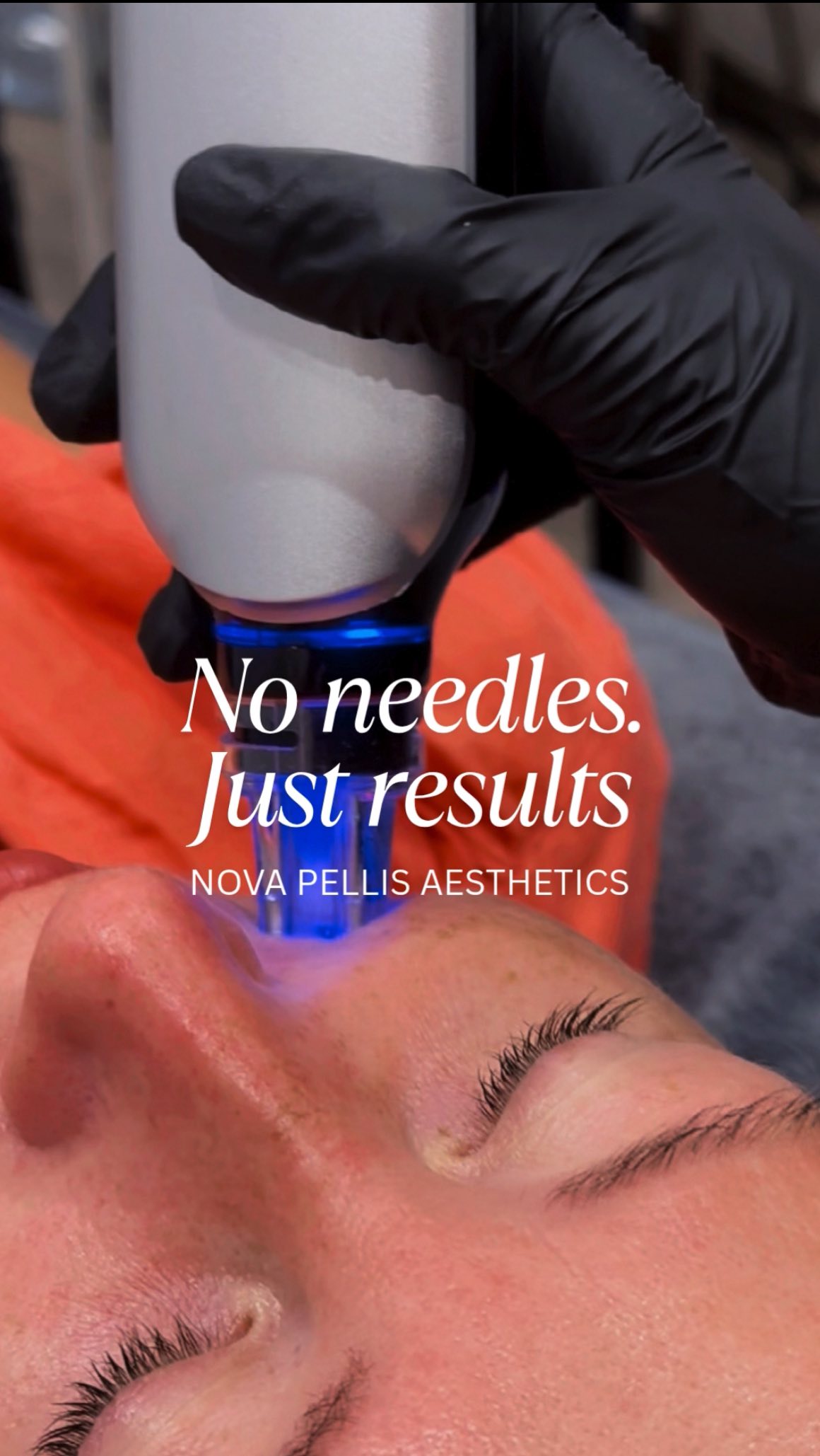 ✨Nova Hydra EMS - Where Technology Meets Skin Science Science ✨
Experience the power of our Nova EMS Nano Mesotherapy, a non-invasive alternative to traditional mesotherapy needles, delivering real results without discomfort.
💎Using RF, EMS, LED technology, this treatment helps to:
✨Deliver active ingredients deep into the skin
✨Boost collagen production
✨Smooth fine lines & wrinkles
✨Firm, lift & tone facial muscles
✨Strengthen overall skin structure
With delicate nano pins and advanced tech, Hydra EMS enhances absorption, improves skin texture, and reveals a more youthful, radiant complexion, with no downtime or side effects.
📍Want to see this in your clinic? DM us or book a demo.
🌐www.novapellisaesthetics.com
💌info@novapellisaesthetics.com
📱0800 009 6397
📱WhatsApp 07497 831533
#novahydra #ems #mesotheraphy #collagenboost #skinrejuvination #faciallifting #glowingskin #novapellis #needlefree #clinicowners #boostrevenue